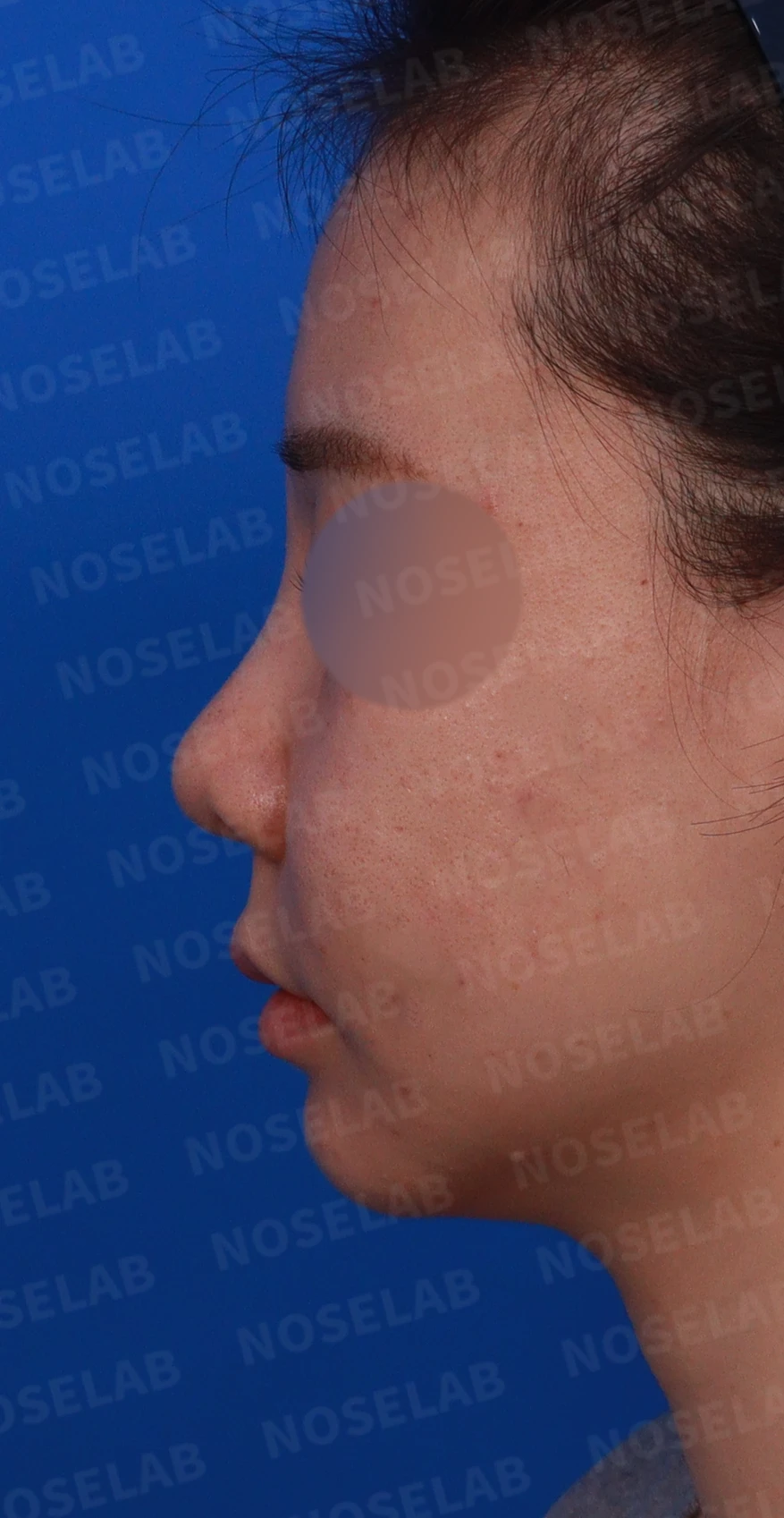 필러와 실 시술 뒤 코가 뭉툭해지는 이유, 이물질 제거와 코끝 교정 방법 — 디자인 상담 정면, 좌측 측면, 비스듬한 측면 사진