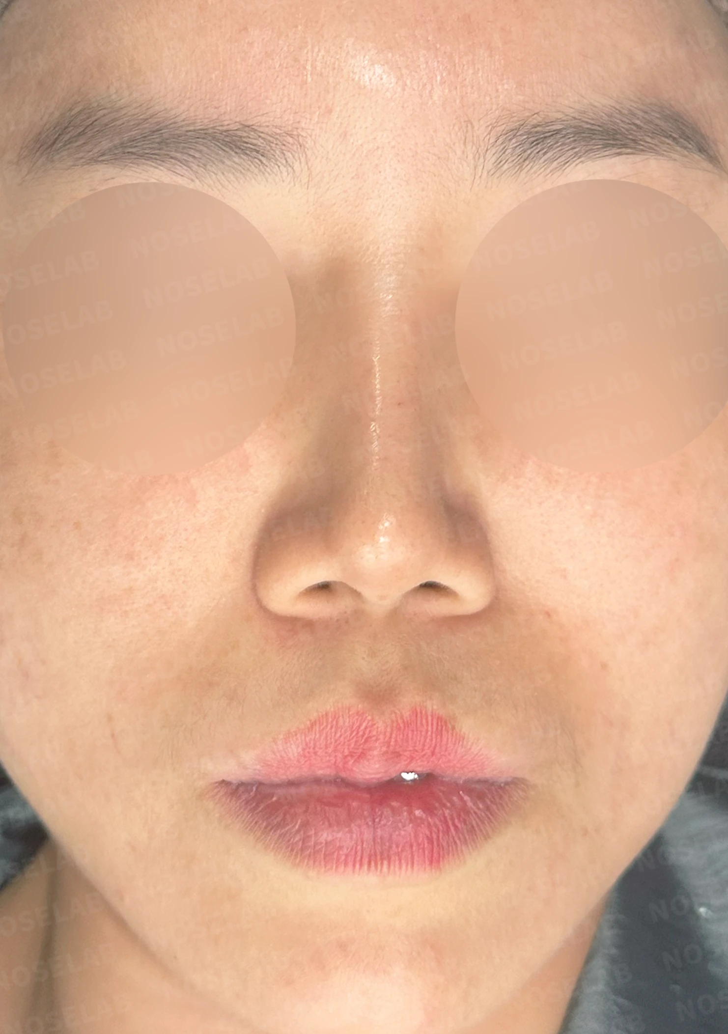 메드포어를 넣은 코에 코막힘이 생기는 이유, 제거와 자가늑연골 비중격 재건은 어떻게 하나 — 수술 전 / 수술 직후 0일 직후 사진은 부기가 있는 상태로 최종 결과와 다를 수 있습니다.