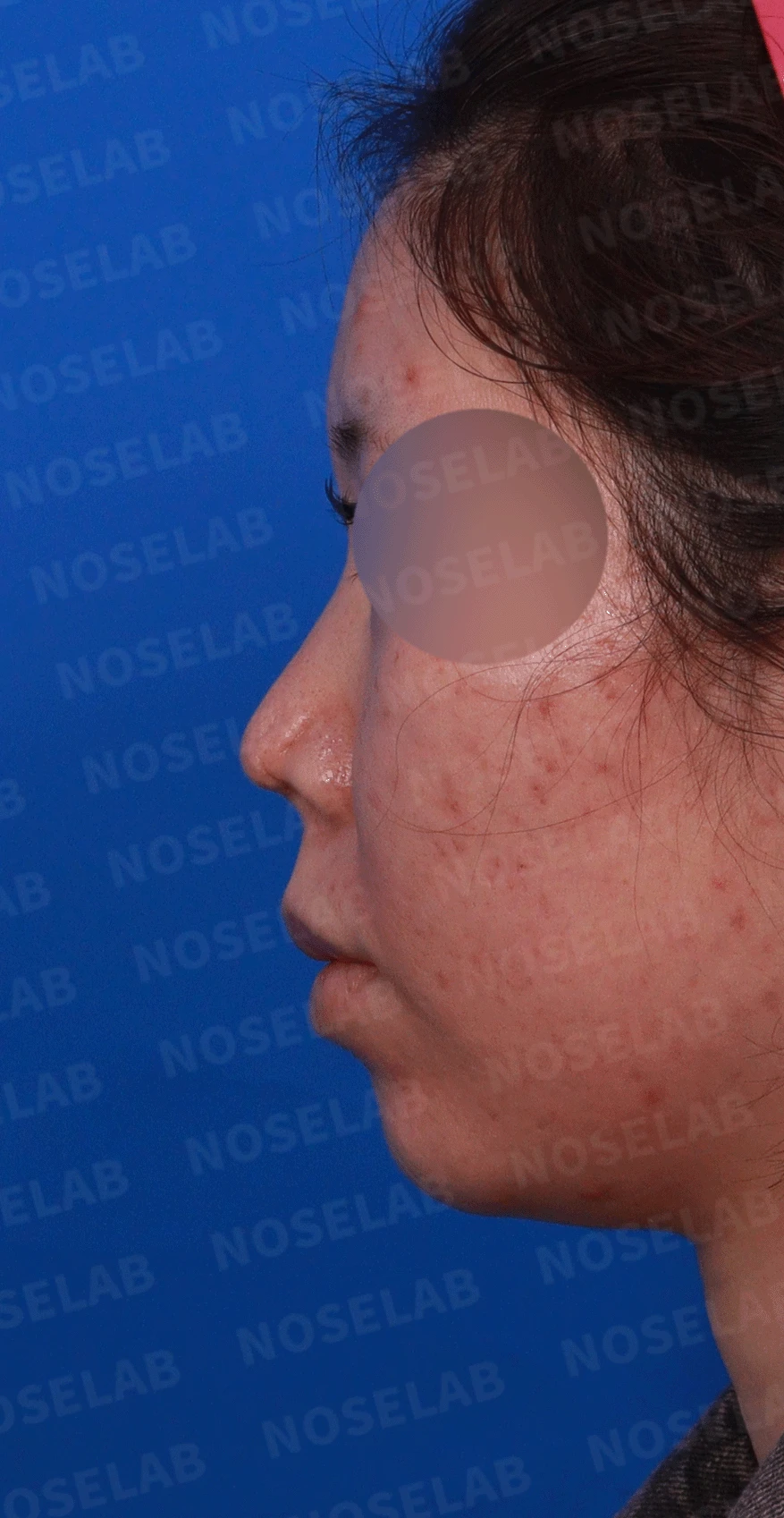 콧구멍을 막는 종괴가 생기는 이유, 제거와 재건은 어떻게 하나 — 디자인 상담 정면 , 좌측 비스듬한 측면 , 측면 사진입니다.