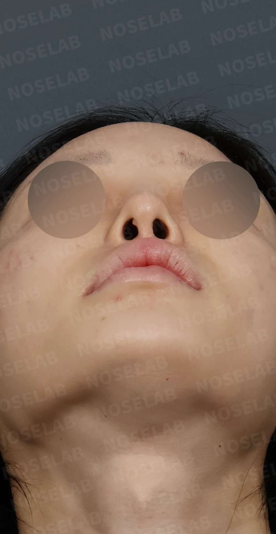 심한 비중격 만곡과 높은 콧대 시작점, 기증늑연골로 정밀 재건 — 디자인 상담 우측 측면, 비스듬한 측면, 비공 사진입니다.
