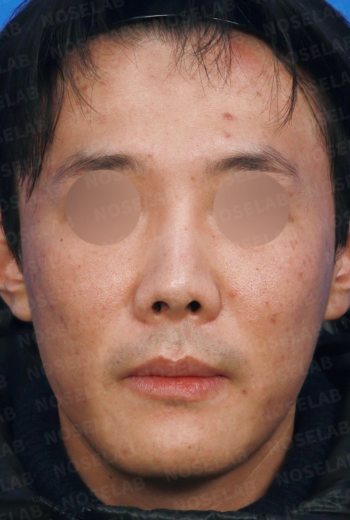 구축이 진행된 코, 조직 제거와 자가 늑연골 재건은 어떻게 하나 — 디자인 상담 정면, 좌측 측면, 비스듬한 측면 사진입니다.