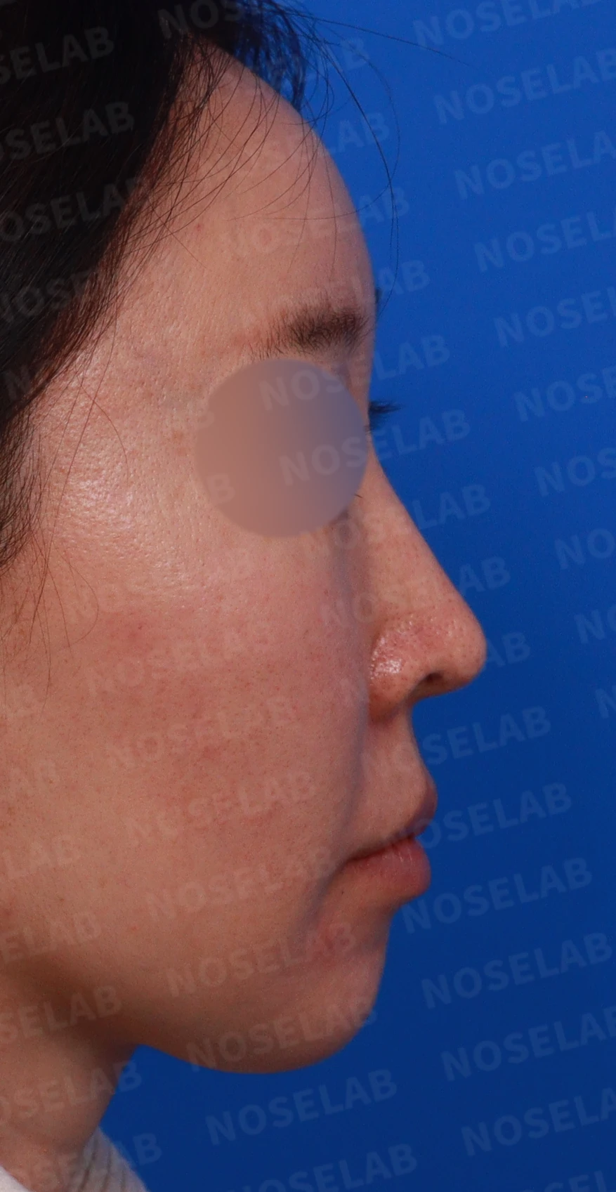 긴 코와 퍼진 콧대의 재수술 방법 — 디자인 상담 우측 비스듬한 측면, 측면, 비공 사진