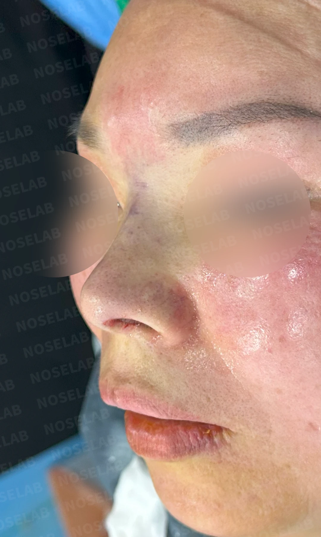 불법 주사 시술 뒤 코가 들리고 짧아지는 이유, 이물질 제거와 재건은 어떻게 하나 — 수술 전 / 수술 직후 0일 직후 사진은 부기가 있는 상태로 최종 결과와 다를 수 있습니다.