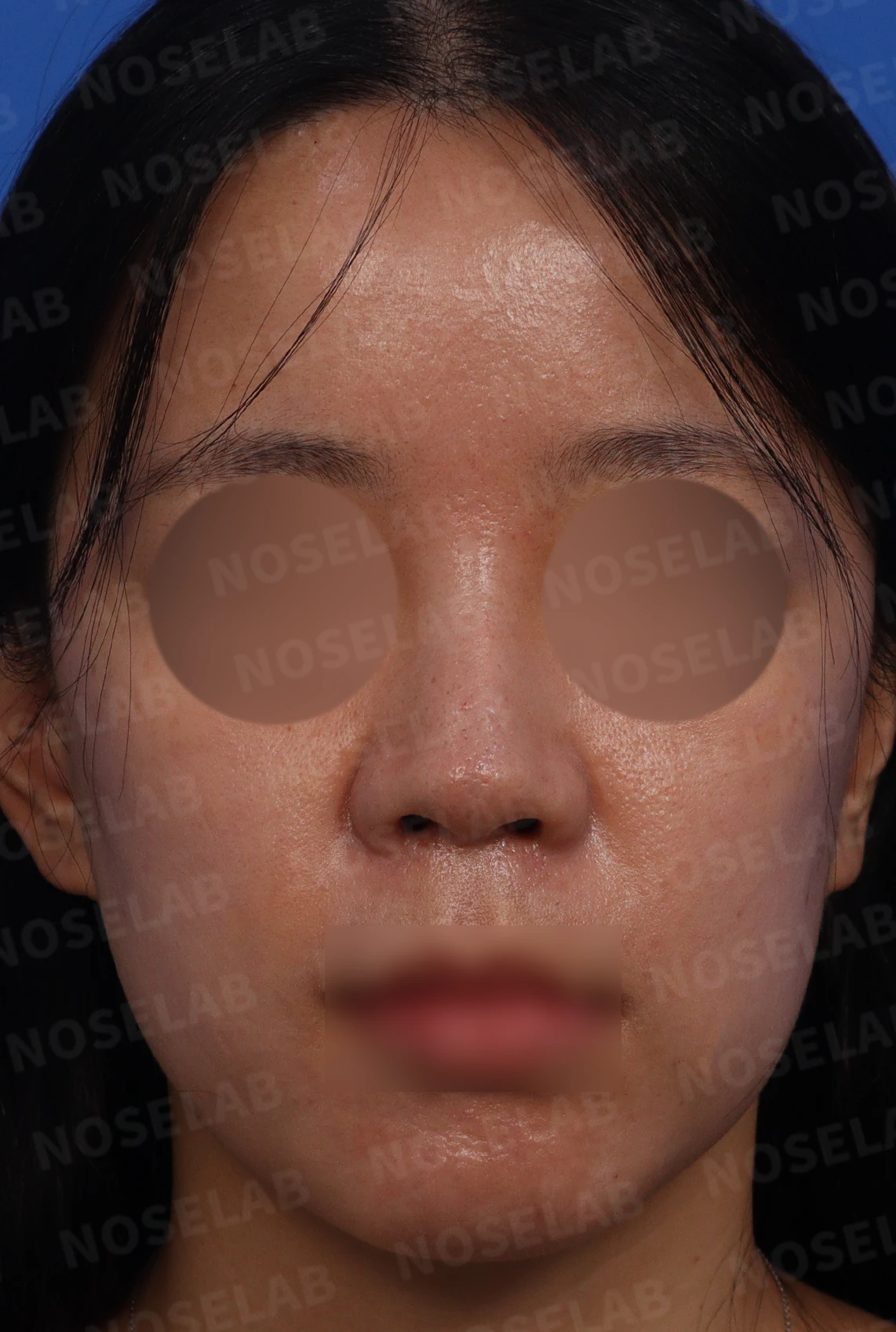 이물질제거후 코성형 방법 — 본문 사진 1