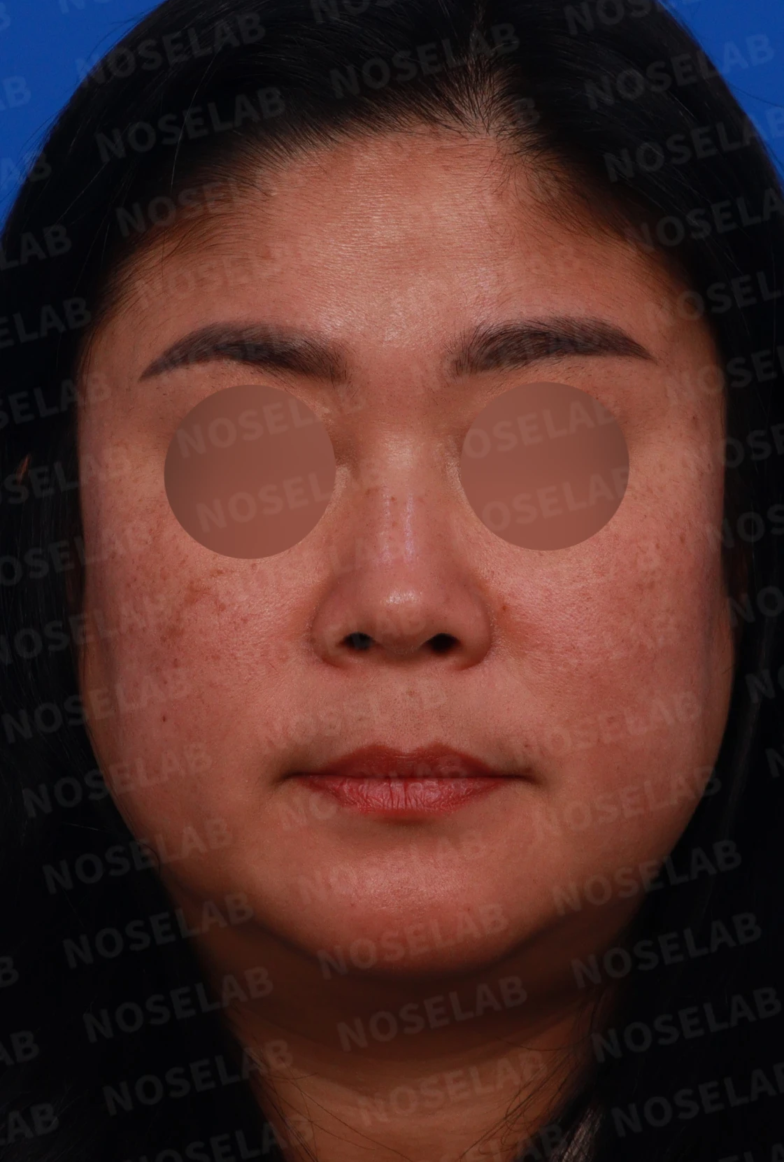 짧은 코와 코막힘을 함께 교정하는 방법 — 디자인 상담 정면, 좌측 측면, 비스듬한 측면 사진입니다.