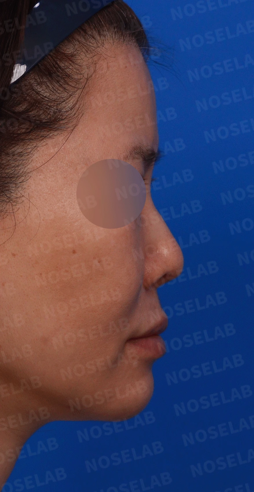 오래된 실리콘이 코끝에서 비쳐 보이는 이유와 제거·재건 방법 — 디자인 상담 우측 측면, 비스듬한 측면, 비공 사진입니다.