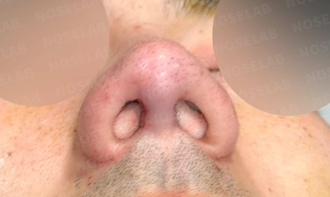 복코에 비공 비대칭과 코막힘이 함께 오는 이유, 직반 라인 교정은 어떻게 하나 — 수술 직후 0일 비공 사진 직후 사진은 부기가 있는 상태로 최종 결과와 다를 수 있습니다.