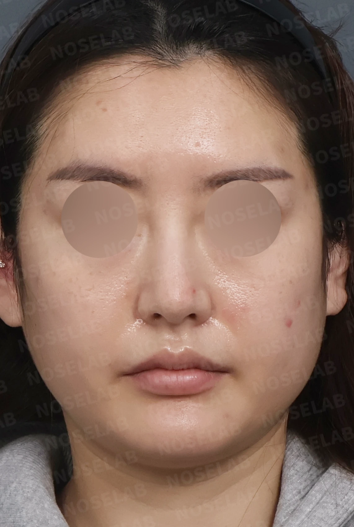 매부리코 교정, 자가늑연골로 자연스러운 코 라인 완성 — 디자인 상담 정면, 좌측 측면, 비스듬한 측면 사진입니다.