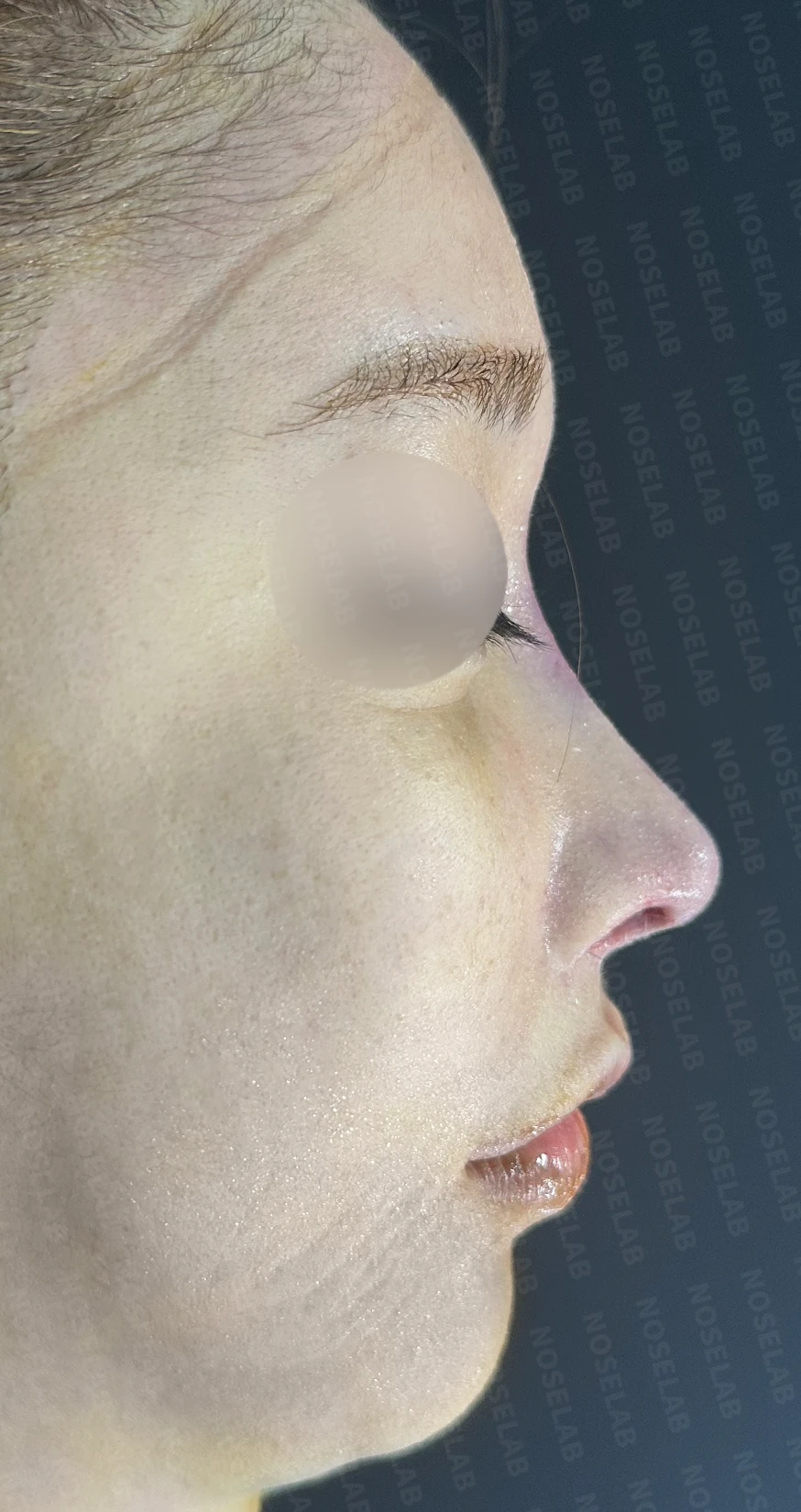 짧고 들린 코교정 방법 — 수술 직후 0일 사진입니다. 정면 45도 90도 직후 사진은 부기가 있는 상태로 최종 결과와 다를 수 있습니다.