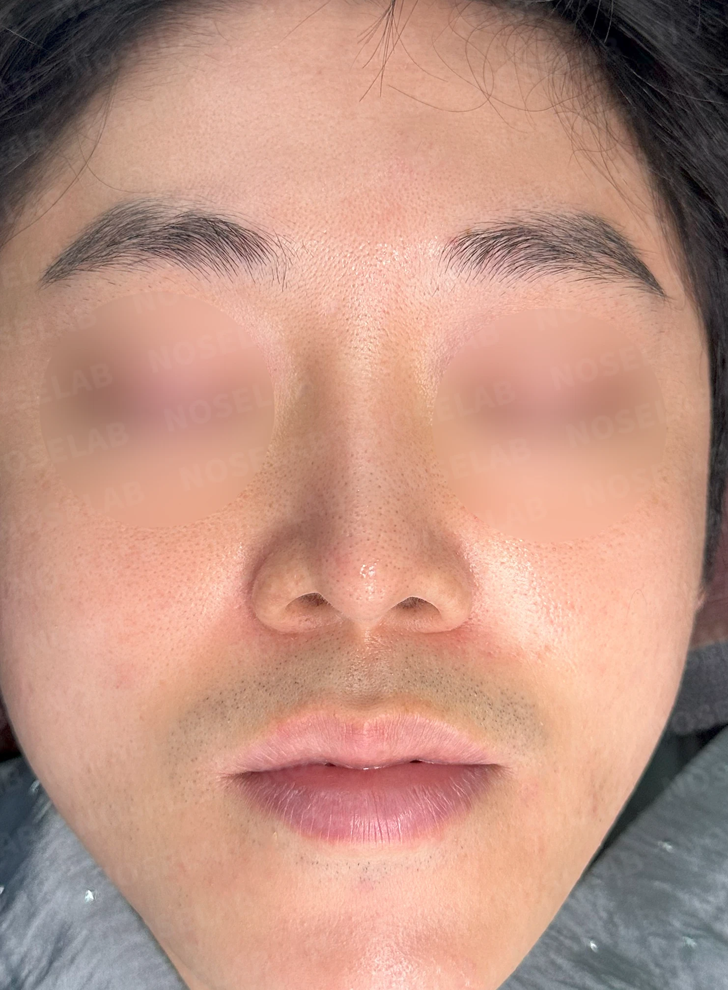 비중격연골 손상으로 무너진 코 수술 방법 — 본문 사진 9