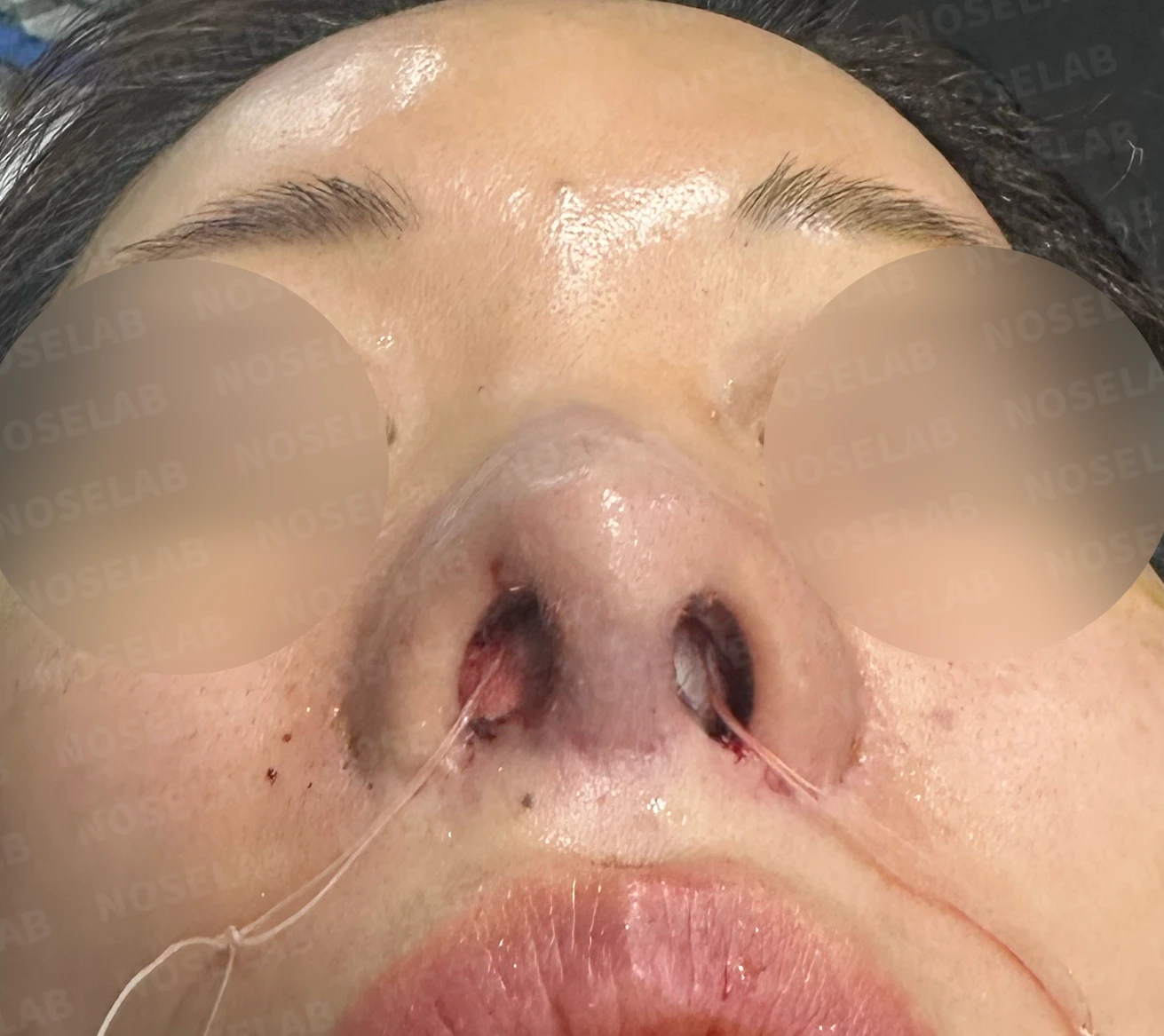 코 수술 뒤 콧등 피부가 괴사하면 어떤 변화가 남고, 재건은 어떻게 하나 — 수술 전 / 수술 직후 0일 직후 사진은 부기가 있는 상태로 최종 결과와 다를 수 있습니다.