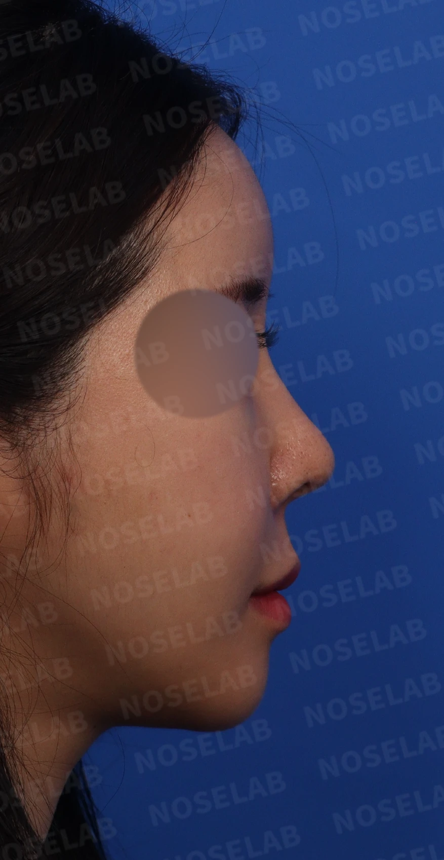 다섯 번의 수술 끝에 찾은 완벽한 코: 들린코와 휜코의 극적인 변신 — 본문 사진 2