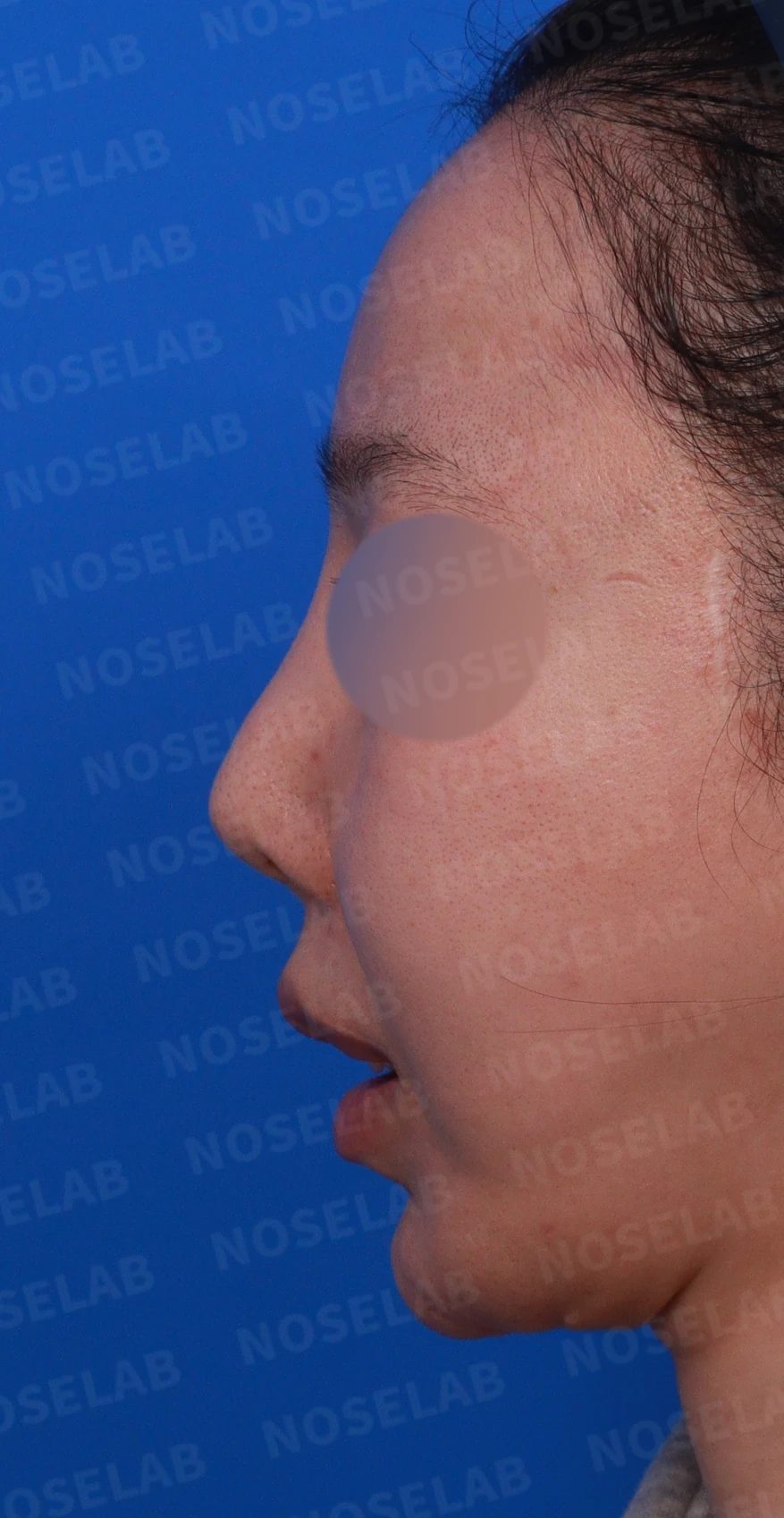 콧대가 뭉툭하게 퍼져 보이는 만성 이물 반응, 원인과 재건 방법 — 디자인 상담 정면, 좌측 측면, 비스듬한 측면 사진