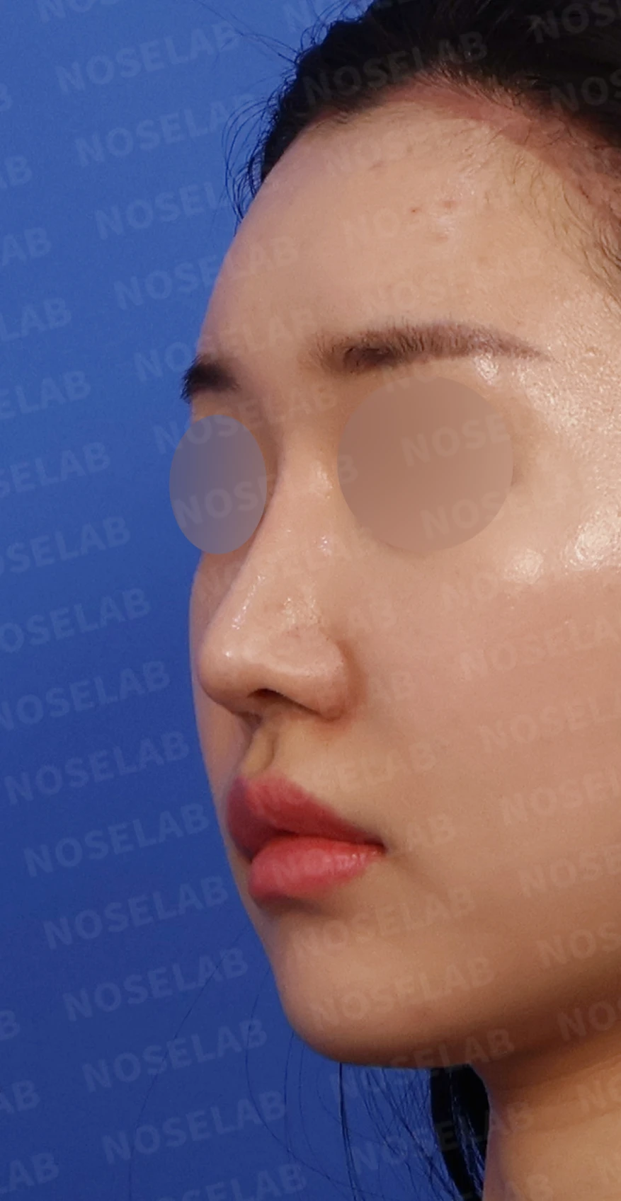 화살코와 복코가 함께 있는 코, 비중격 재건부터 시작하는 이유 — 디자인 상담 정면, 좌측 측면, 비스듬한 측면 사진입니다.