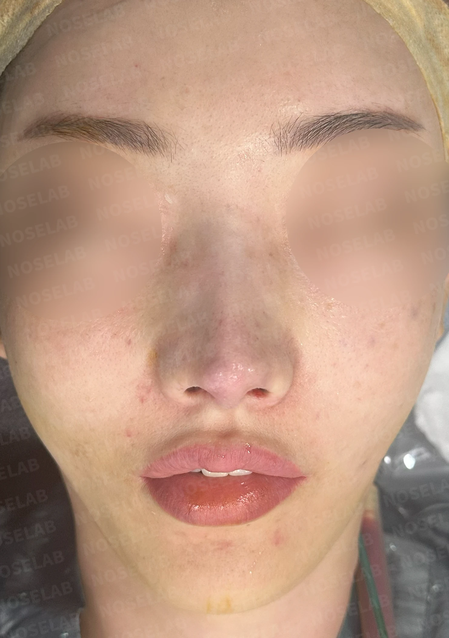 코성형 후 염증이 반복되는 이유와 자가 조직만으로 재건하는 방법 — 수술 직후 0일 정면 , 비스듬한 측면 , 측면 사진입니다. 직후 사진은 부기가 있는 상태로 최종 결과와 다를 수 있습니다.