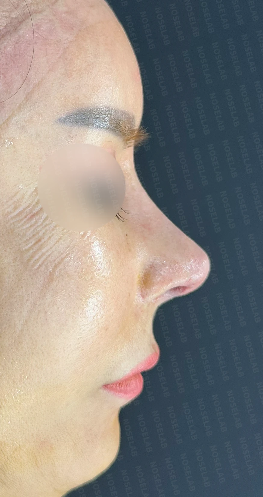 휜코와 뭉툭한 코끝, 콧구멍 비대칭의 비개방 교정 방법 — 수술 직후 0일 정면, 측면, 비스듬한 측면 사진 직후 사진은 부기가 있는 상태로 최종 결과와 다를 수 있습니다.