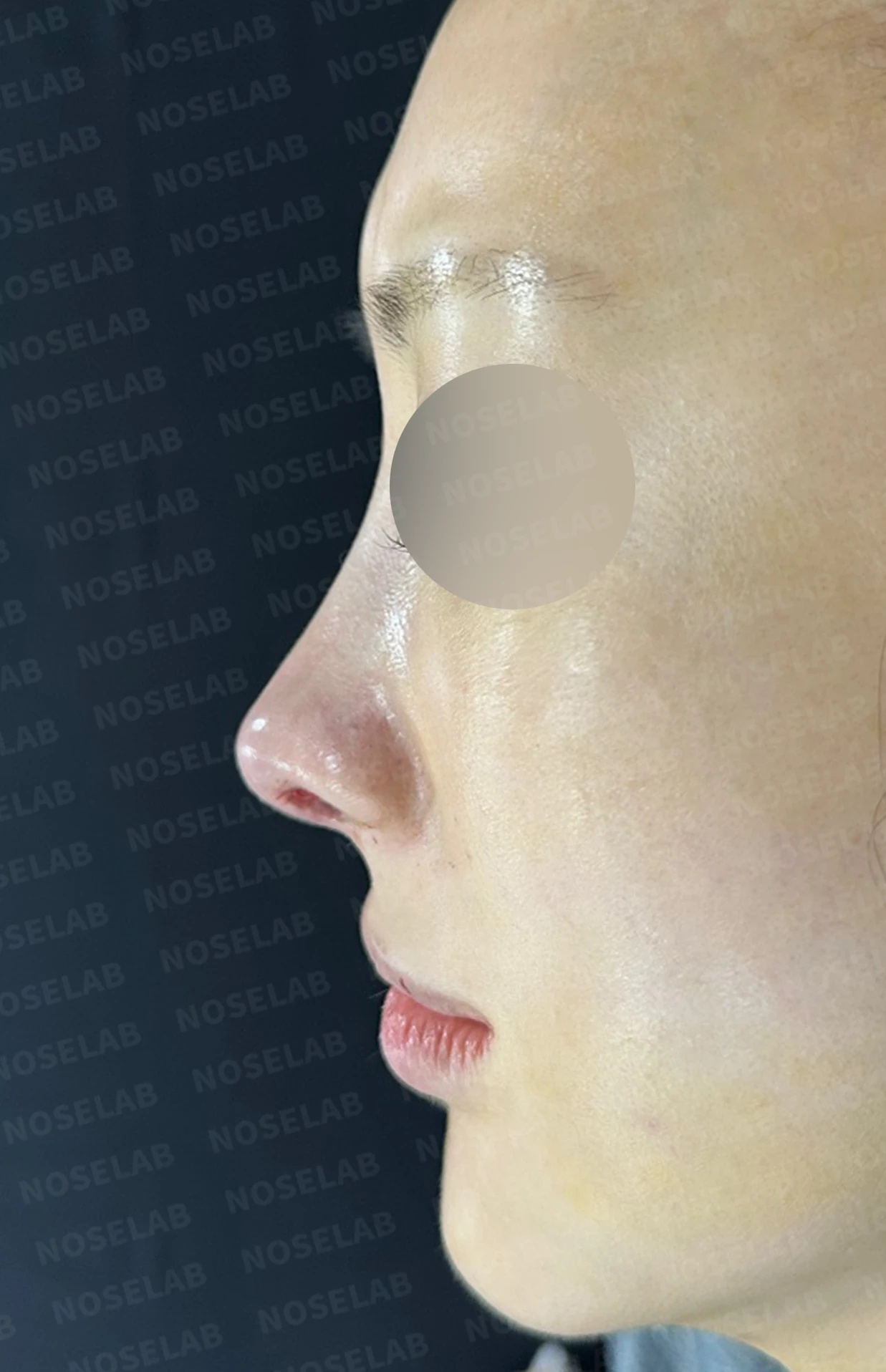 뾰족한 코끝과 연골 비침 - 자가진피 코 재수술 후기 — 전(좌) 직후(우)
