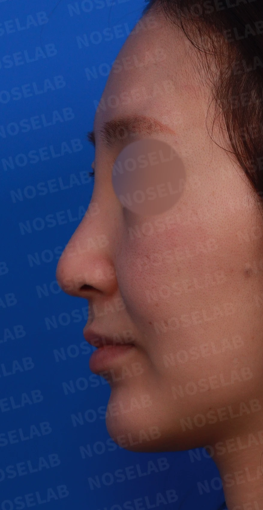 녹이지 않은 코필러가 퍼지고 축농증이 겹칠 때, 제거와 교정은 어떻게 하나 — 디자인 상담 정면, 좌측 측면, 비스듬한 측면 사진