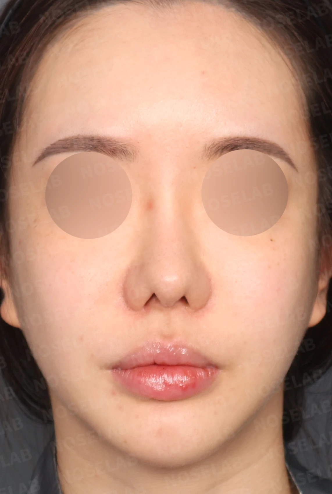 긴 코와 비공 비대칭, 자가늑연골로 자연스럽게 교정한 코재수술 — 디자인 상담 정면, 좌측 측면, 비스듬한 측면