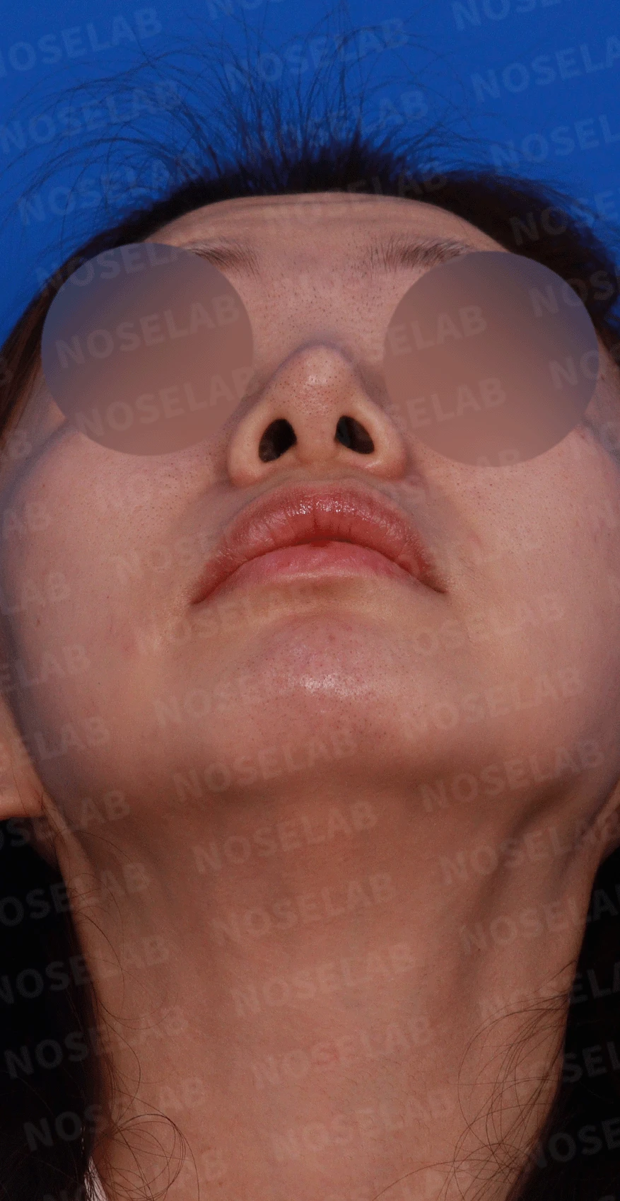 코끝 고어텍스가 문제를 일으키는 이유와 늑연골 비중격 재건 방법 — 디자인 상담 우측 측면, 비스듬한 측면, 비공 사진입니다.