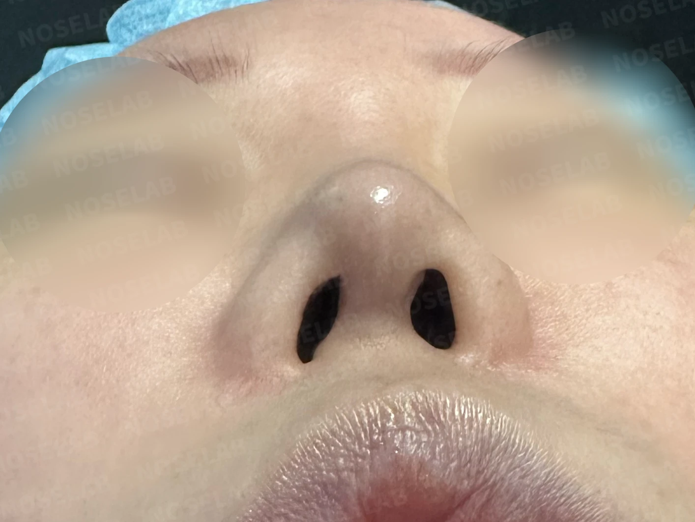비주 함몰과 복코, 비공 비대칭의 교정 방법 — 수술 전 / 수술 직후 0일 직후 사진은 부기가 있는 상태로 최종 결과와 다를 수 있습니다.