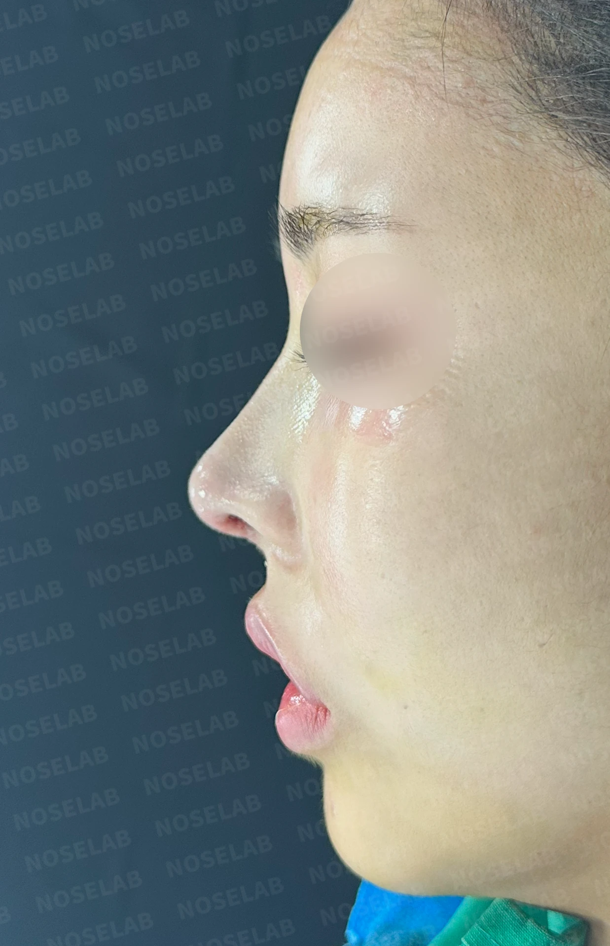 적절하지 않은 L자 실리콘 개선 - 안전한 구조로 재건 후기 — 직후 정면, 비스듬한 측면, 측면 사진