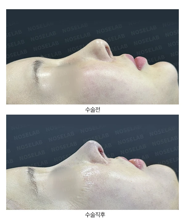 수술 후 14일 조기 교정에서 확인할 점 — 본문 사진 13