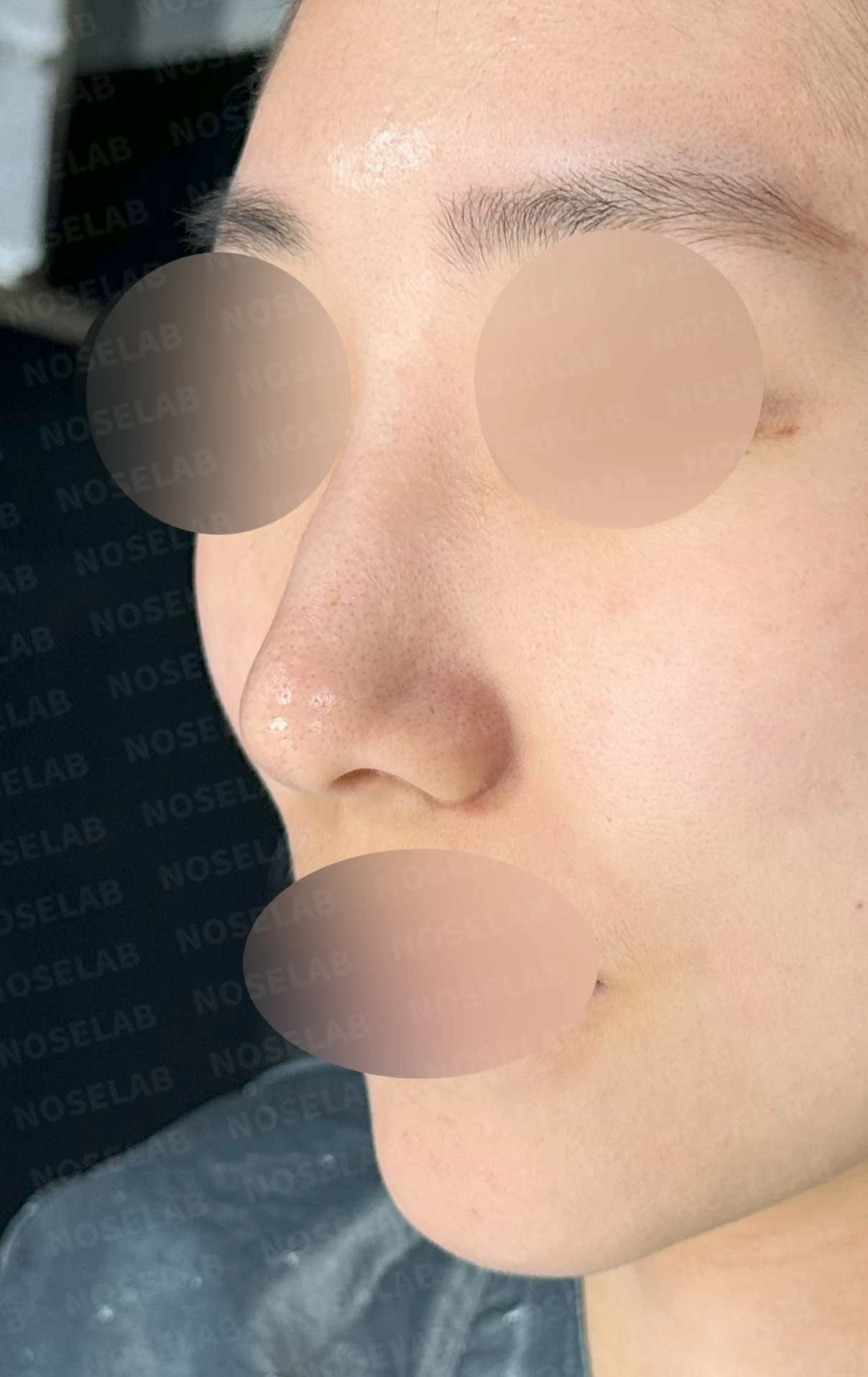 매부리를 정리한 뒤 콧등이 눌려 보이고 코끝이 뭉툭해지는 이유, 보형물 없이 교정하는 방법 — 수술 전 / 수술 직후 0일 직후 사진은 부기가 있는 상태로 최종 결과와 다를 수 있습니다.
