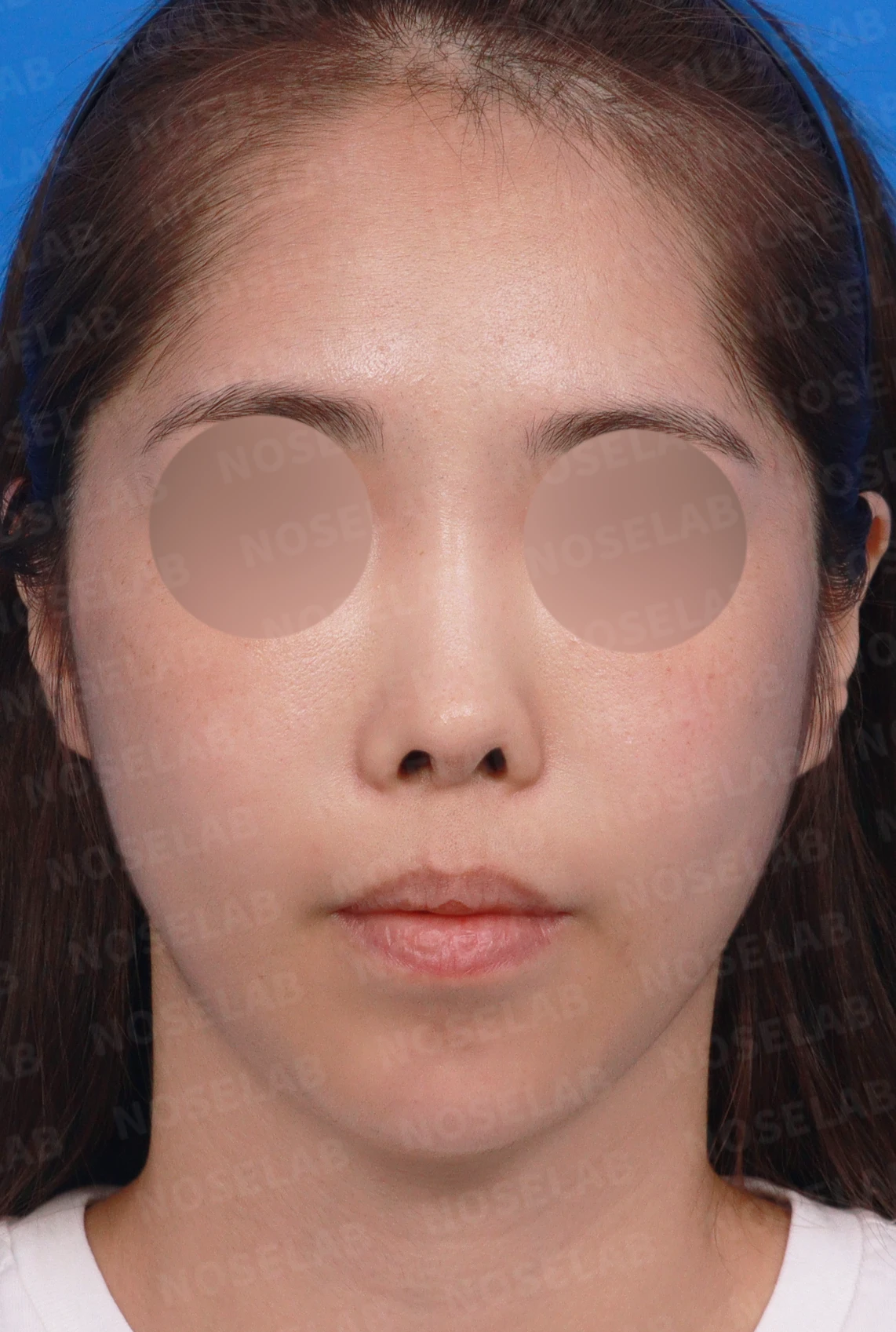 보형물을 넣고 빼기를 반복한 코에 남는 콧등 패임과 들린 느낌 — 디자인 상담 정면 , 좌측 비스듬한 측면 , 측면 사진입니다.