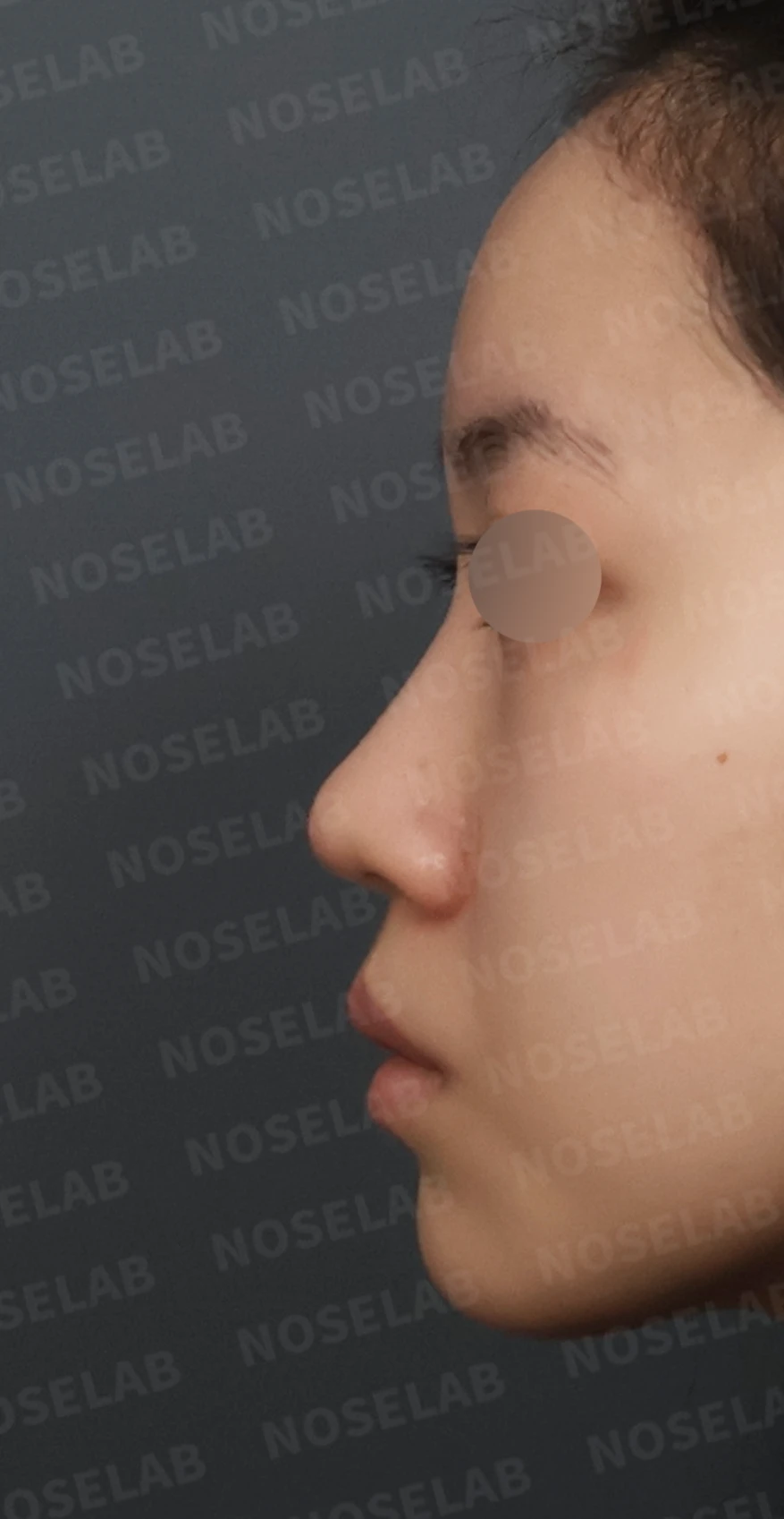 복코와 주먹코, 자가늑연골로 얄쌍하고 여성스러운 코 완성 — 디자인 상담 정면, 좌측 측면, 비스듬한 측면 사진입니다.