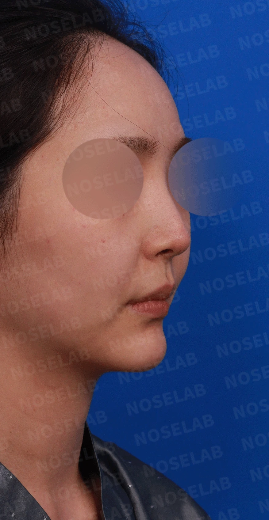 코끝 처짐과 코막힘을 함께 살펴보는 재수술 방법 — 디자인 상담 우측 측면, 비스듬한 측면, 비공 사진입니다.
