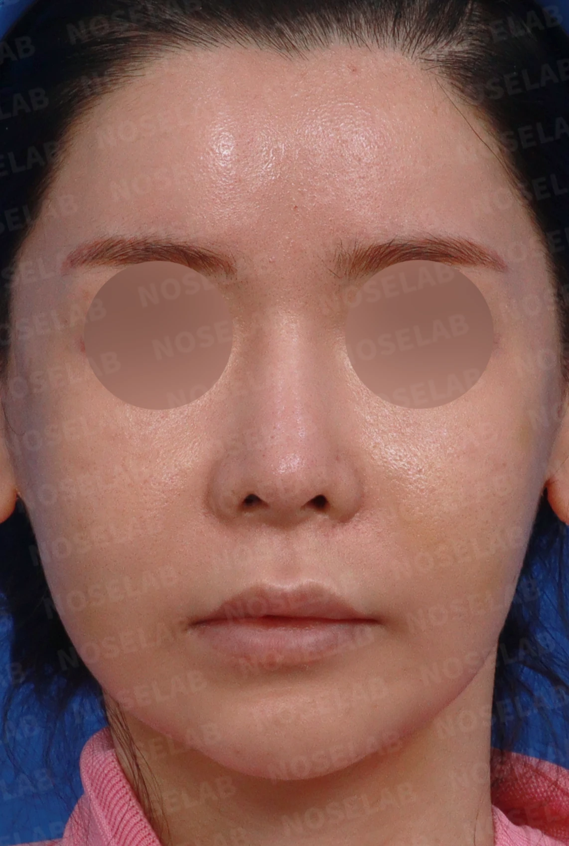 양악 수술 뒤 코가 퍼지고 낮아지는 이유와 비중격 재건 — 디자인 상담 정면, 좌측 측면, 비스듬한 측면 사진입니다.