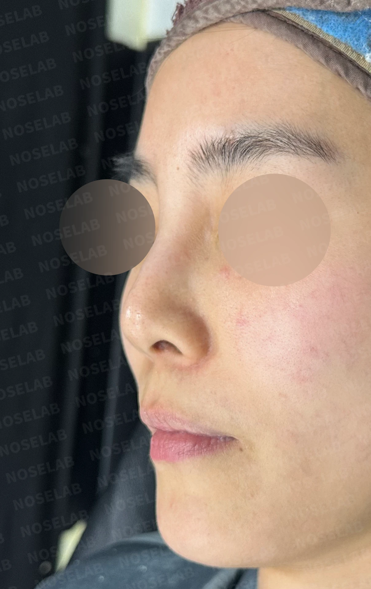 여러 차례 받은 코필러가 남긴 퍼진 코와 코막힘, 어떻게 정리하나 — 수술 전 / 수술 직후 0일 직후 사진은 부기가 있는 상태로 최종 결과와 다를 수 있습니다.