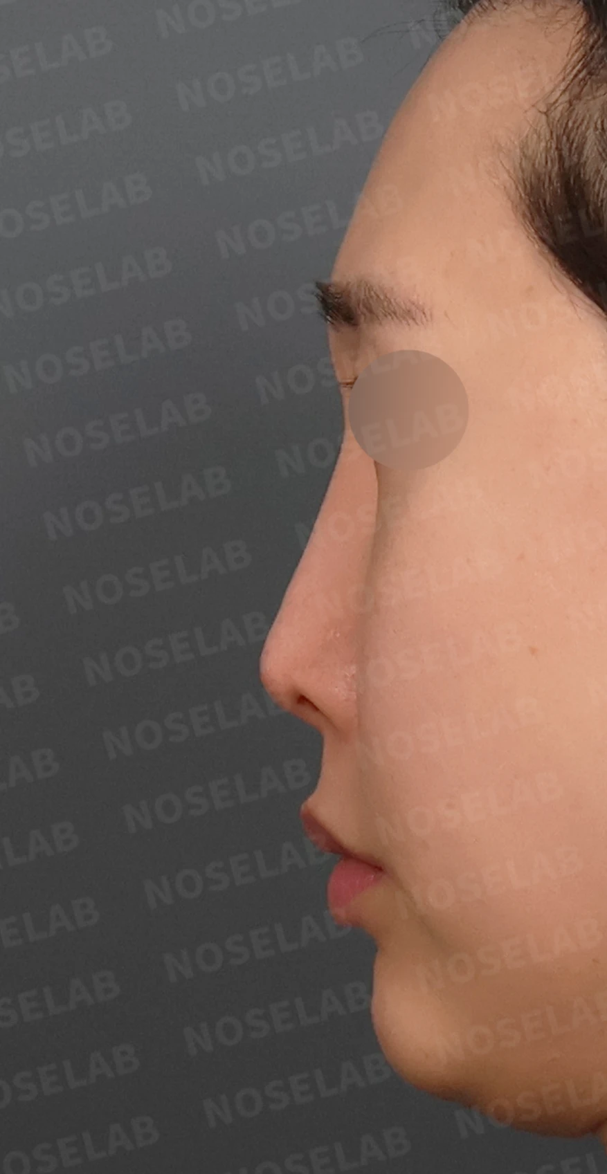 실리콘이 휘고 코가 길어 보이는 이유, 보형물 교체와 늑연골 재건은 어떻게 하나 — 디자인 상담 정면, 좌측 측면, 비스듬한 측면 사진입니다.