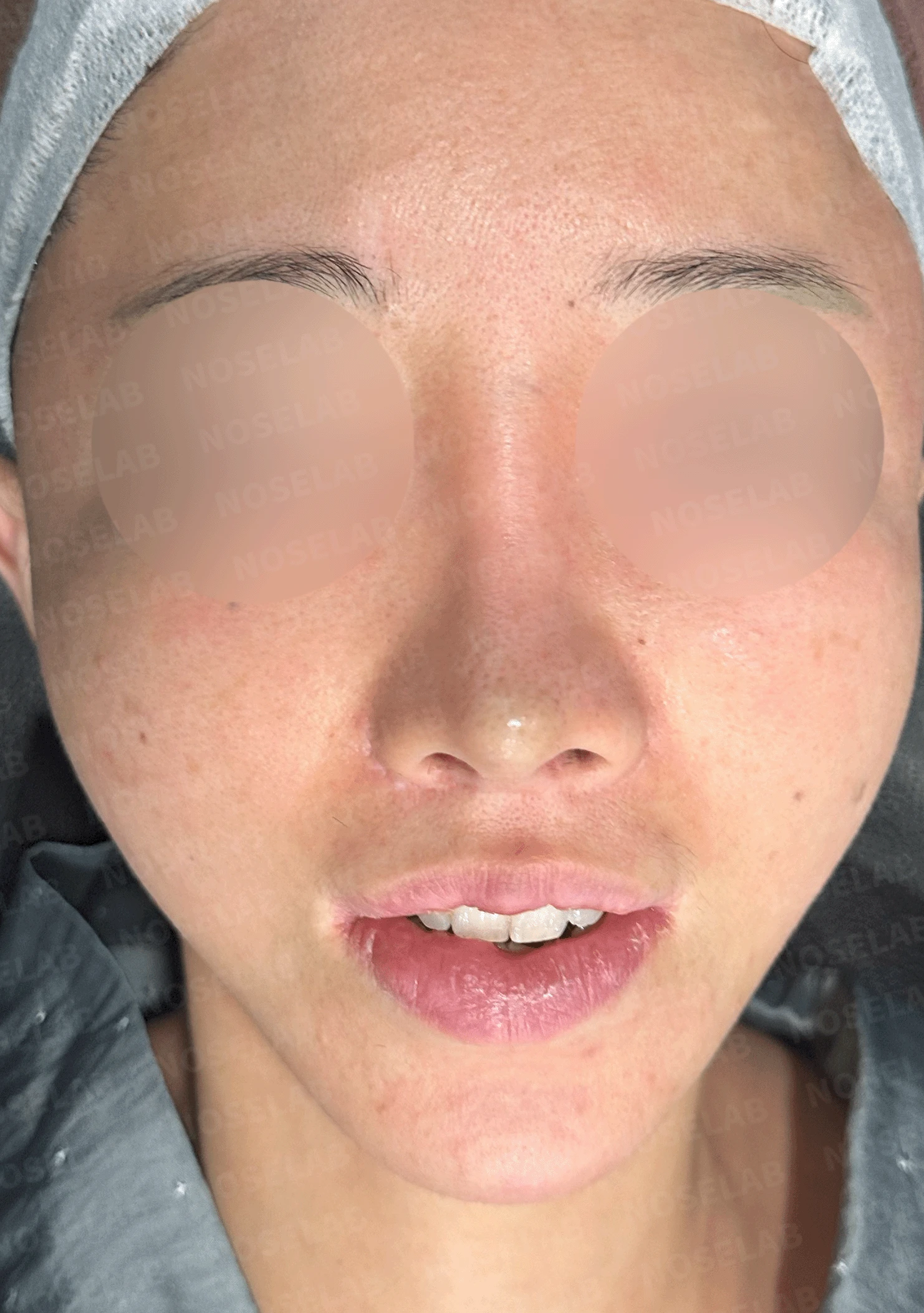 다수 재수술 후 인공진피 흡수와 비중격 손상 재건 사례 — 전(좌) 직후(우)