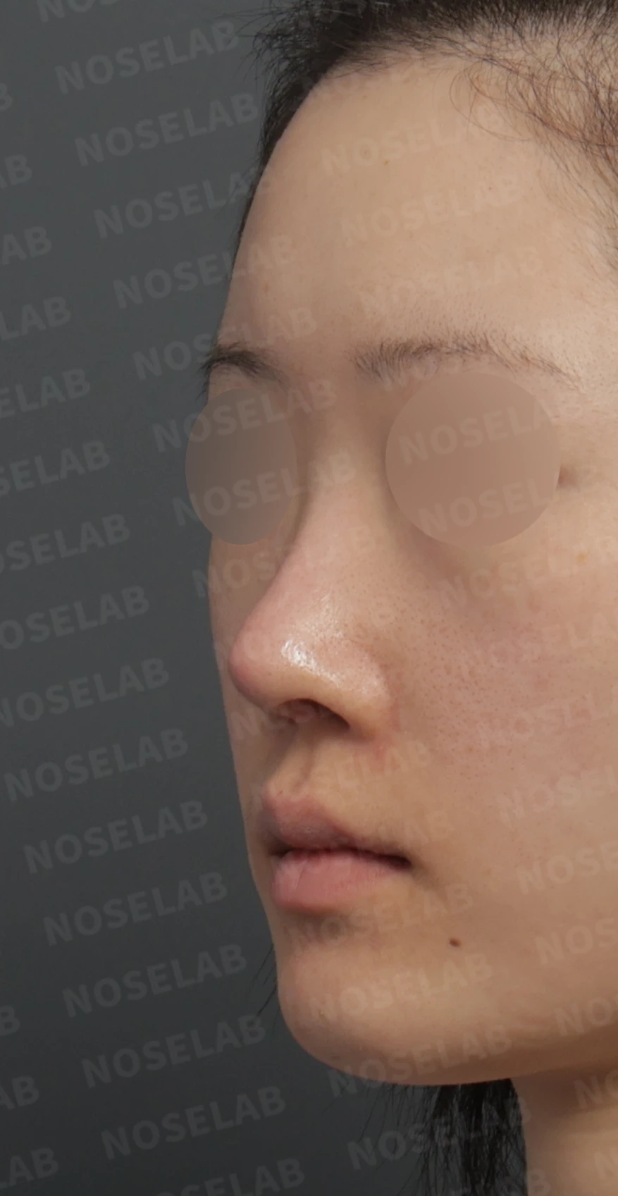 보형물 비침과 들린 코, 자가늑연골로 안전하게 교정한 코재수술 — 디자인 상담 정면 , 좌측 비스듬한 측면 , 측면 사진입니다.