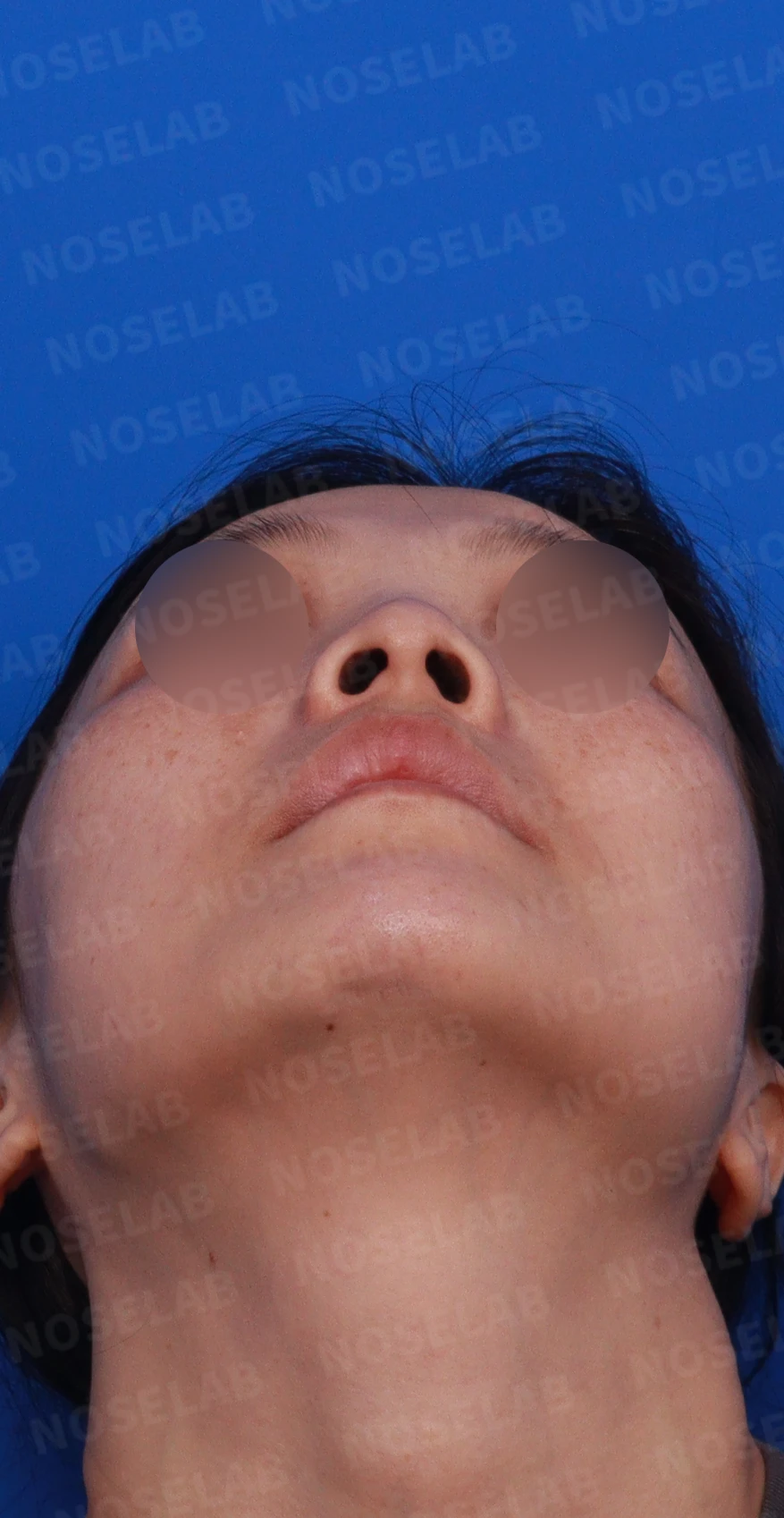 첫 코성형에서 코끝 구조와 콧구멍 노출은 어떻게 다루나 — 디자인 상담 우측 측면 , 비스듬한 측면 , 비공 사진입니다.