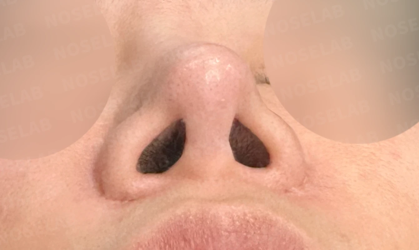 흡수된 기증늑연골을 자가늑연골로 교체 사례 — 전(좌) 직후(우)