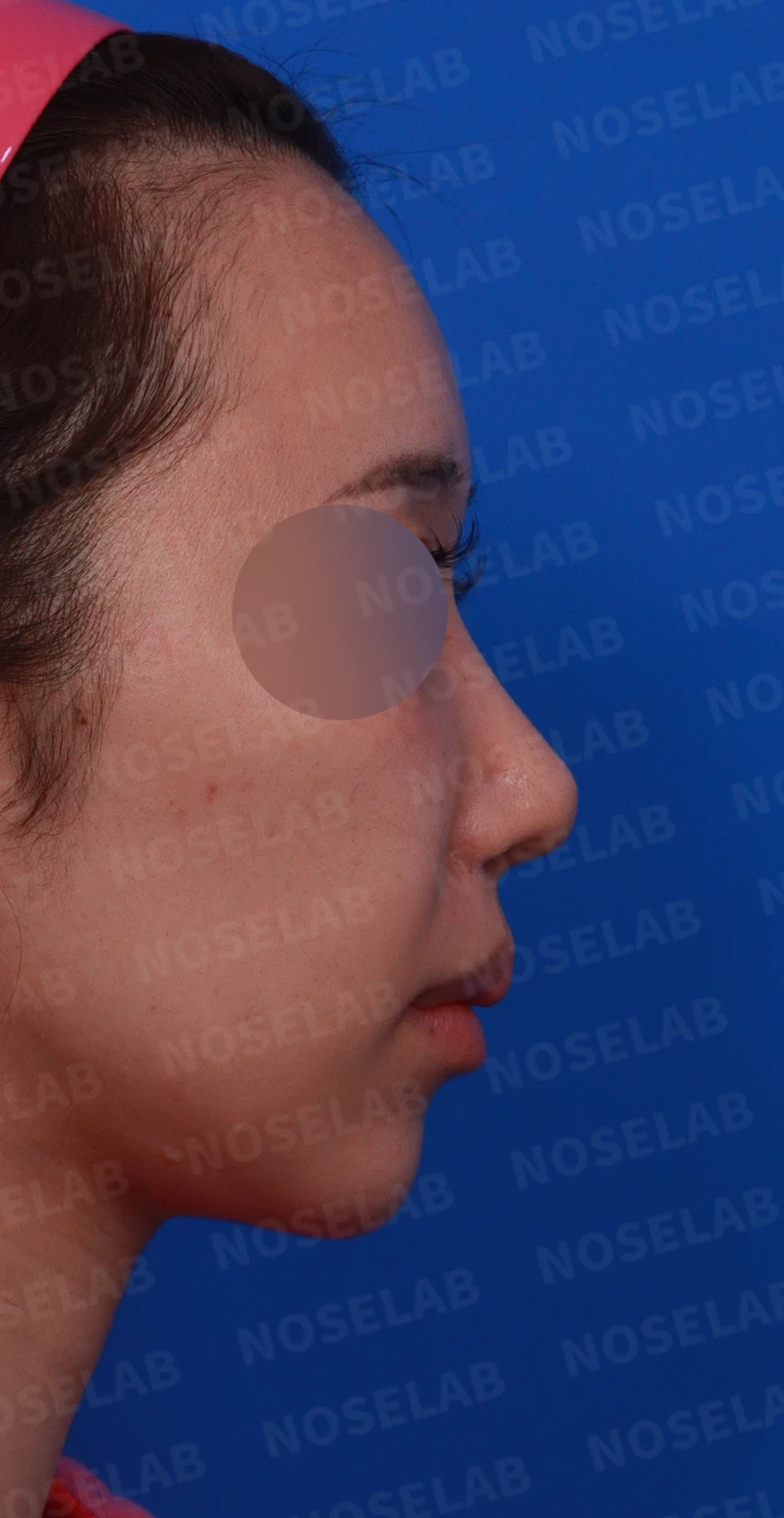 콧구멍 비대칭과 협착이 생기는 이유, 늑연골 재건과 Z성형은 어떻게 하나 — 디자인 상담 우측 비스듬한 측면, 측면, 비공 사진입니다.