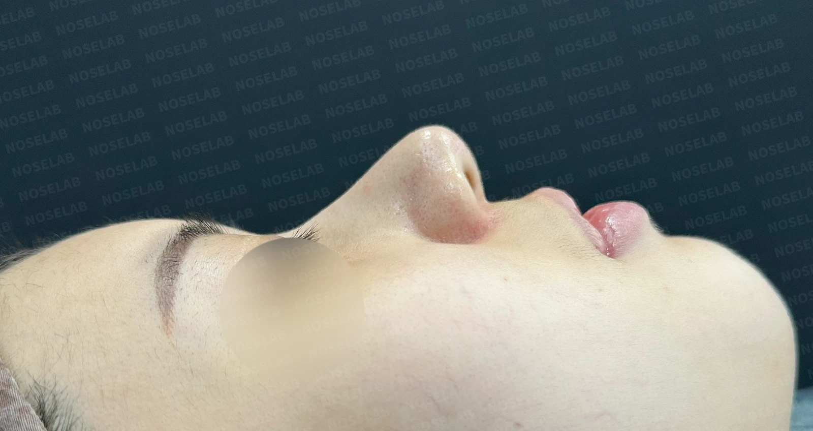 뭉툭한 코에서 화려한 코로의 변신: 맞춤형 코성형 여정 — 수술전(좌) 수술직후(우)