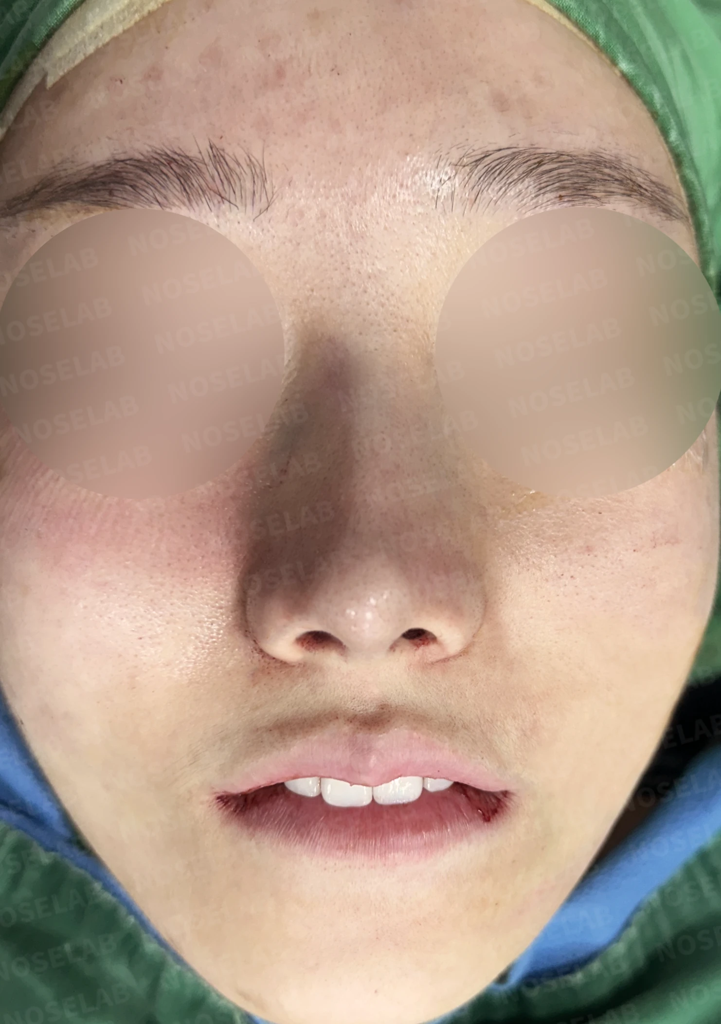 뭉툭하고 처진 긴코, 비개방 코재수술로 여성스러운 직반라인 완성 — 직후 정면, 비스듬한 측면, 측면 사진입니다.