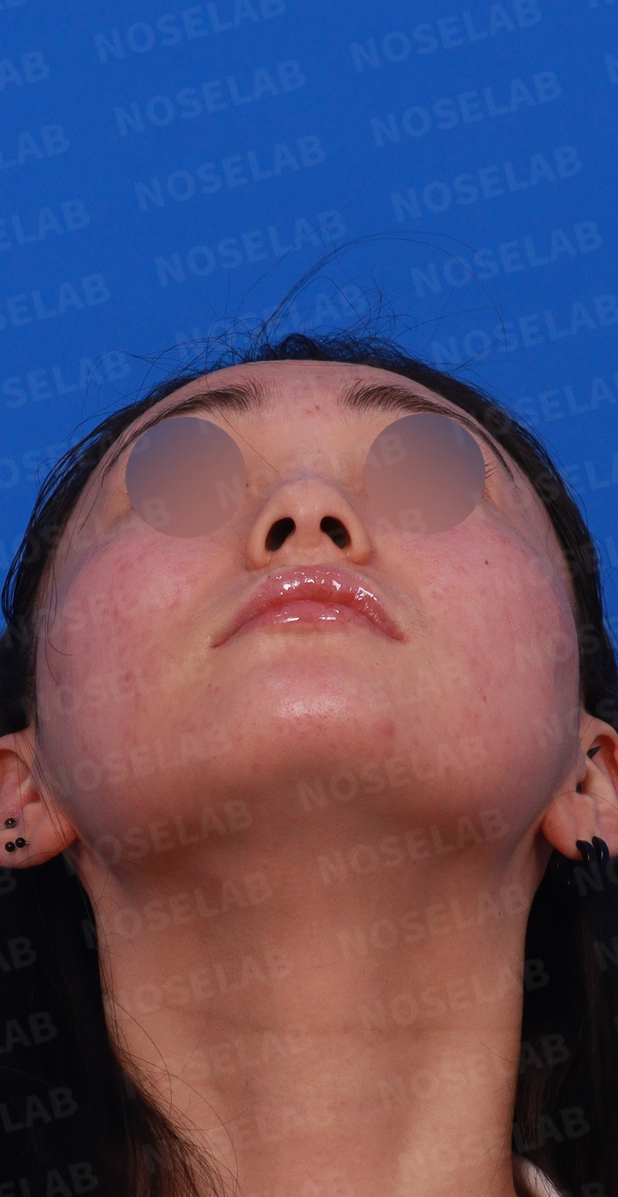 코끝이 뭉툭하게 퍼지고 코가 휘어 보이는 이유, 늑연골 재건은 어떻게 하나 — 디자인 상담 우측 측면 , 비스듬한 측면 , 비공 사진입니다.