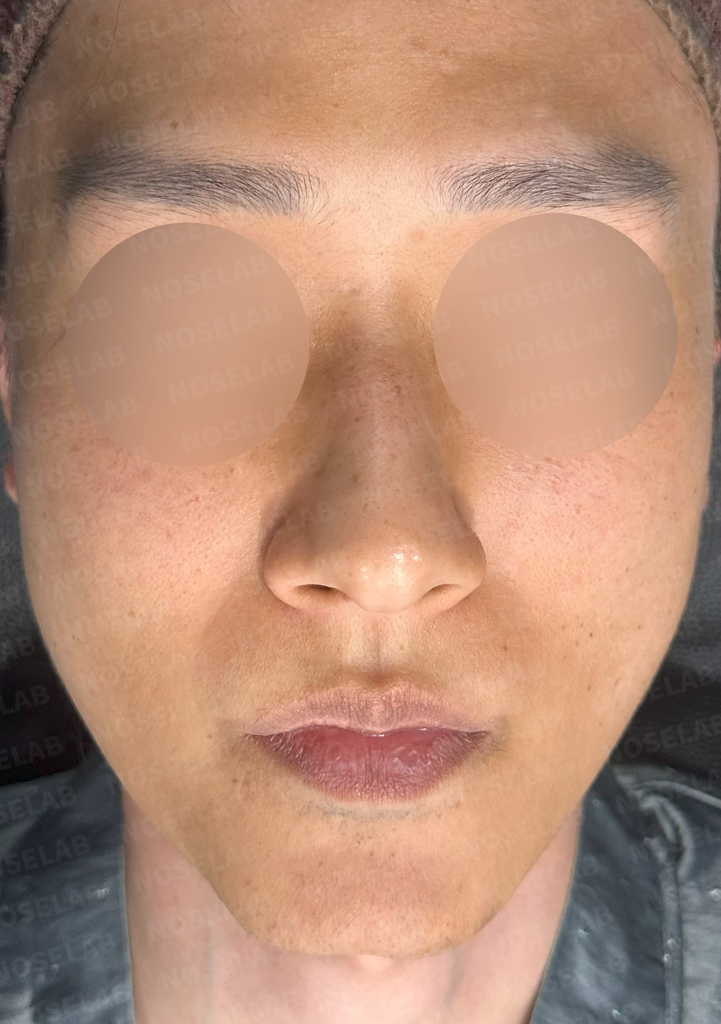 안면 비대칭이 있는 코에 맞춤형 보형물을 쓰는 이유와 매부리 교정 방법 — 본문 사진 8