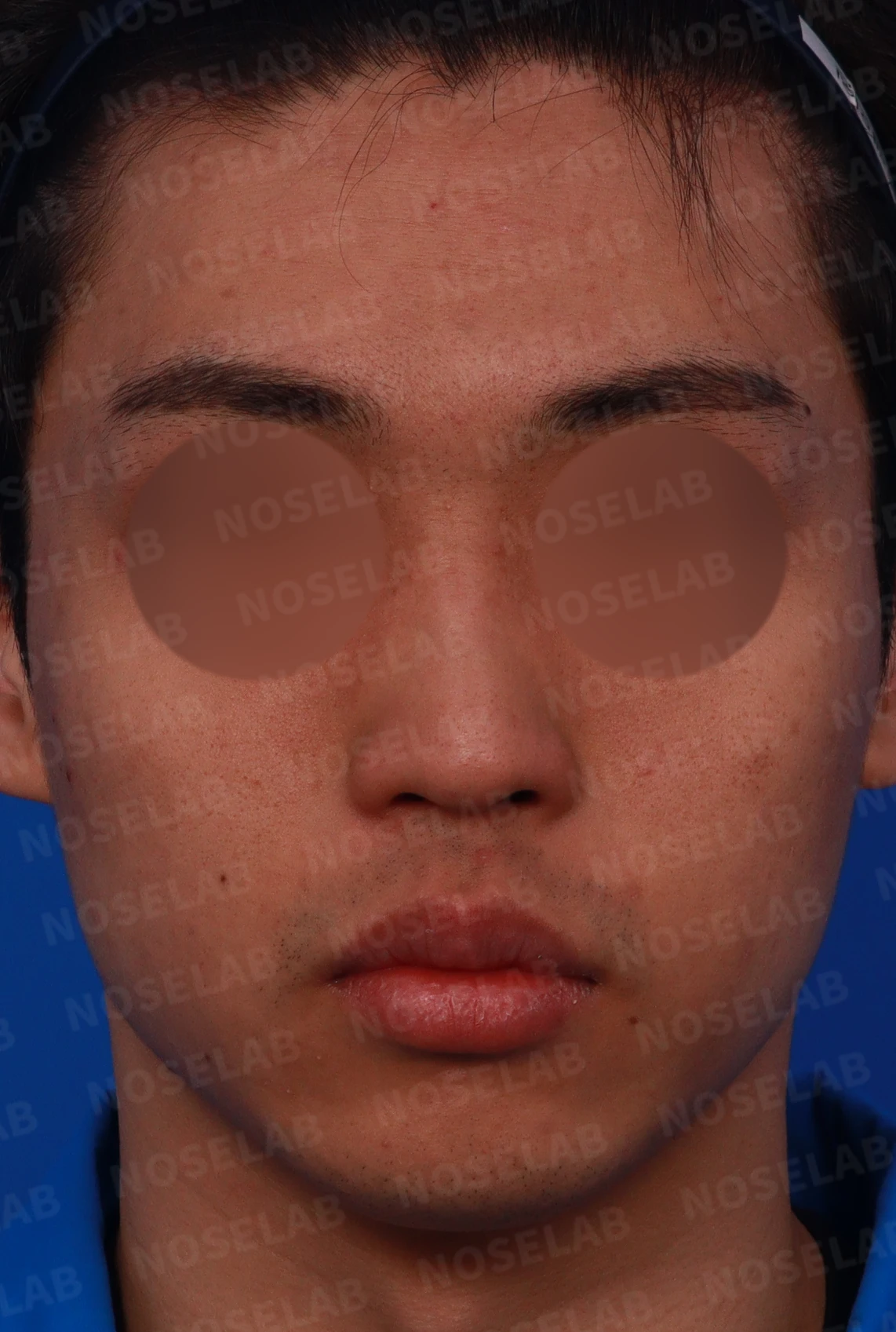 비염 수술 뒤에도 증상이 재발하는 이유, 휜 코를 함께 교정하는 방법 — 디자인 상담 정면, 좌측 측면, 비스듬한 측면 사진