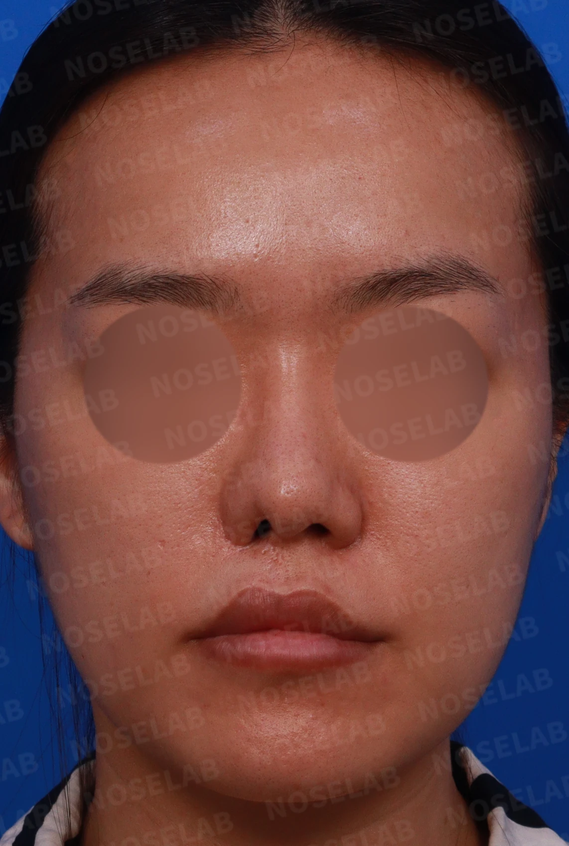 구순구개열에 동반된 코 변형의 교정 방법 — 디자인 상담 사진입니다. 정면, 좌측 비스듬한 측면, 측면