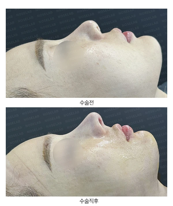 비익과 비공 비대칭의 재수술 방법 — 전후 비교