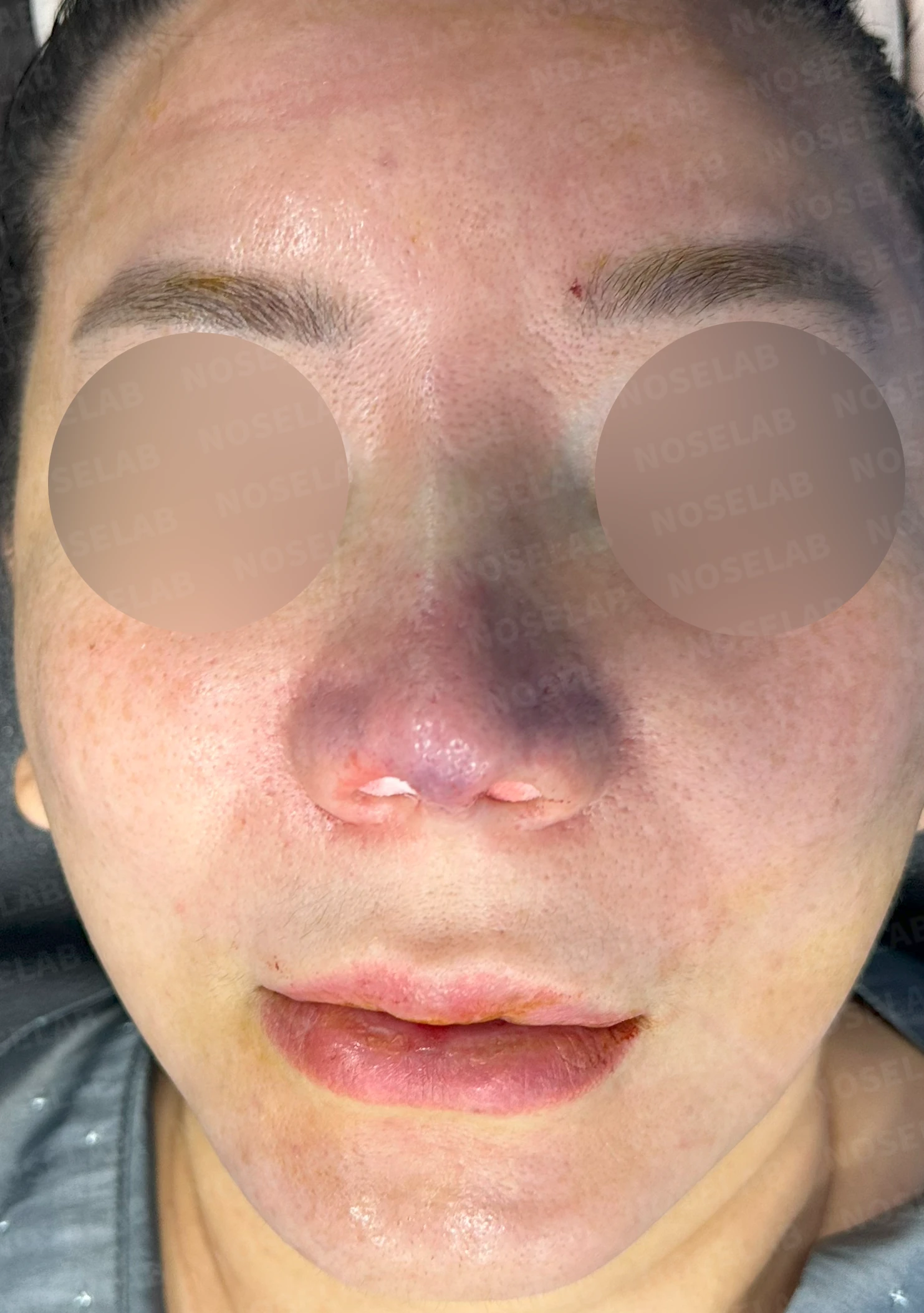 코끝이 찝히고 비주가 함몰되는 이유, 메드포어 제거와 재건은 어떻게 하나 — 수술 전 / 수술 직후 0일 직후 사진은 부기가 있는 상태로 최종 결과와 다를 수 있습니다.
