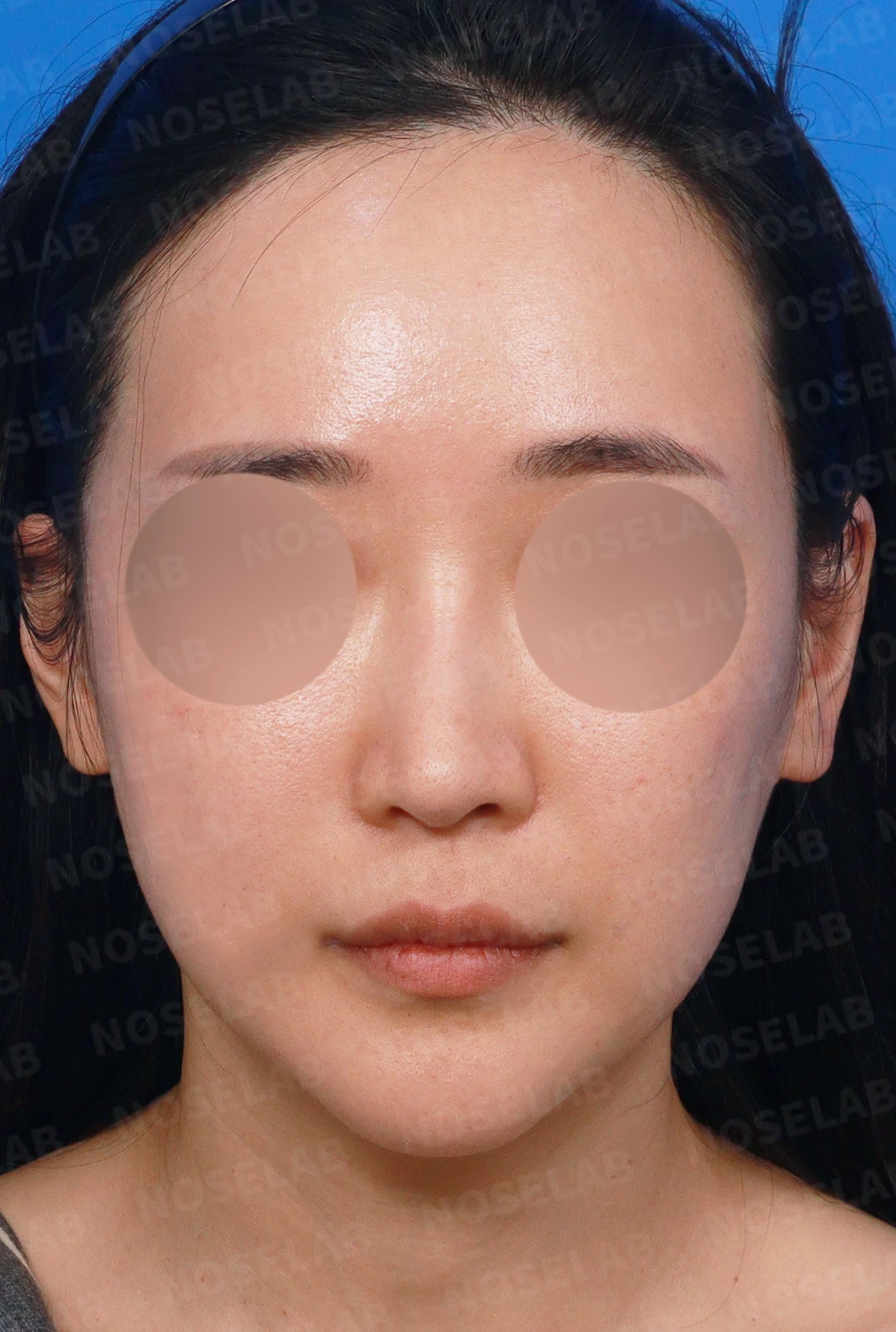 여러 번 수술한 코의 L-strut이 얇아지는 이유와 구조적 재건 방법 — 디자인 상담 정면, 좌측 측면, 비스듬한 측면 사진