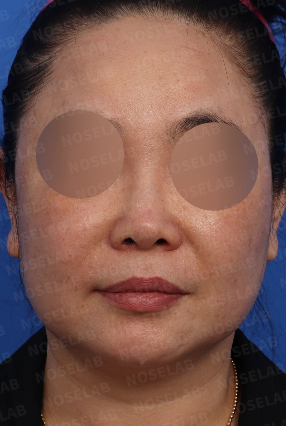 작고 들린 코에서 필러 제거와 교정을 계획하는 방법 — 디자인 정면, 비스듬한 측면, 측면 사진