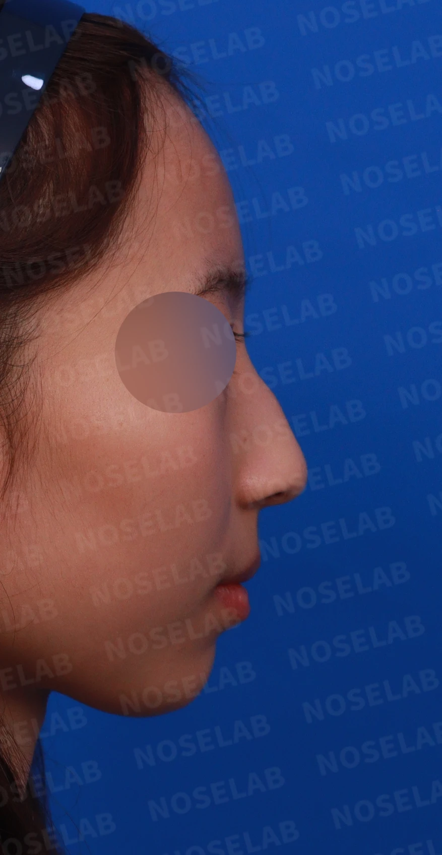 외상 뒤 심해진 매부리와 휜 코, 변화를 최소로 두는 교정 방법 — 디자인 상담 우측 측면, 비스듬한 측면, 비공 사진